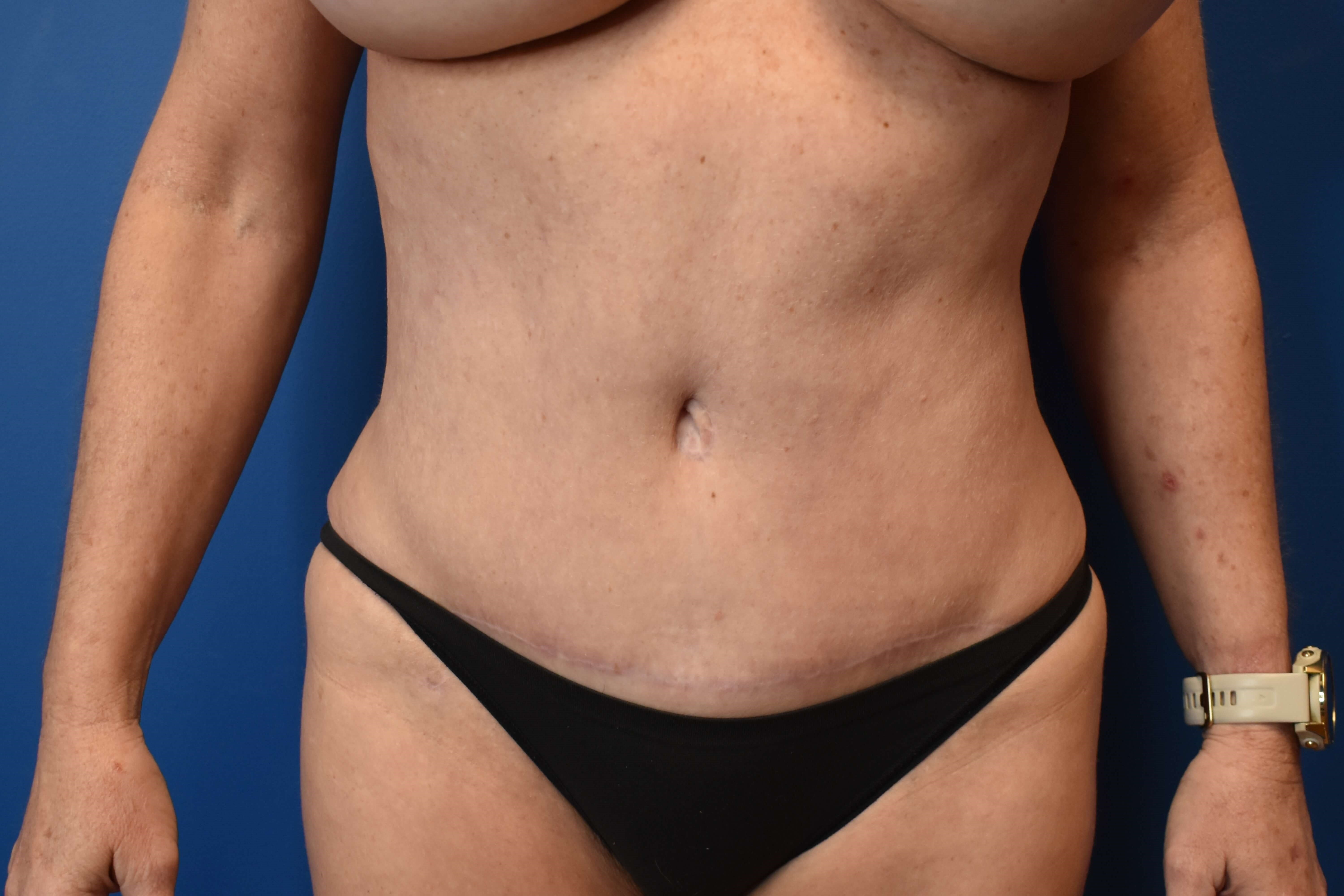 Abdominoplasty with Vaser Lipo After