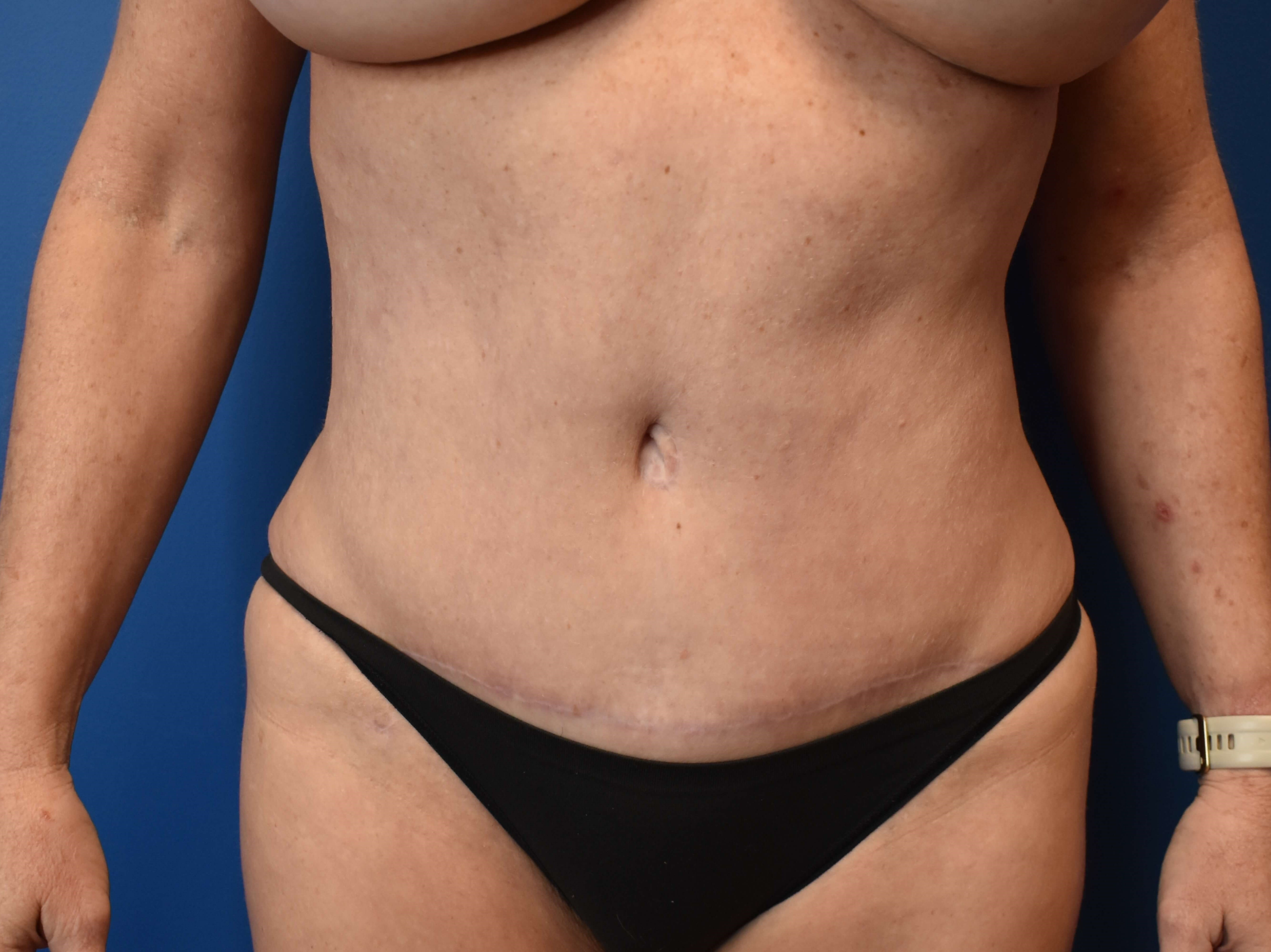 Abdominoplasty with Vaser Lipo After