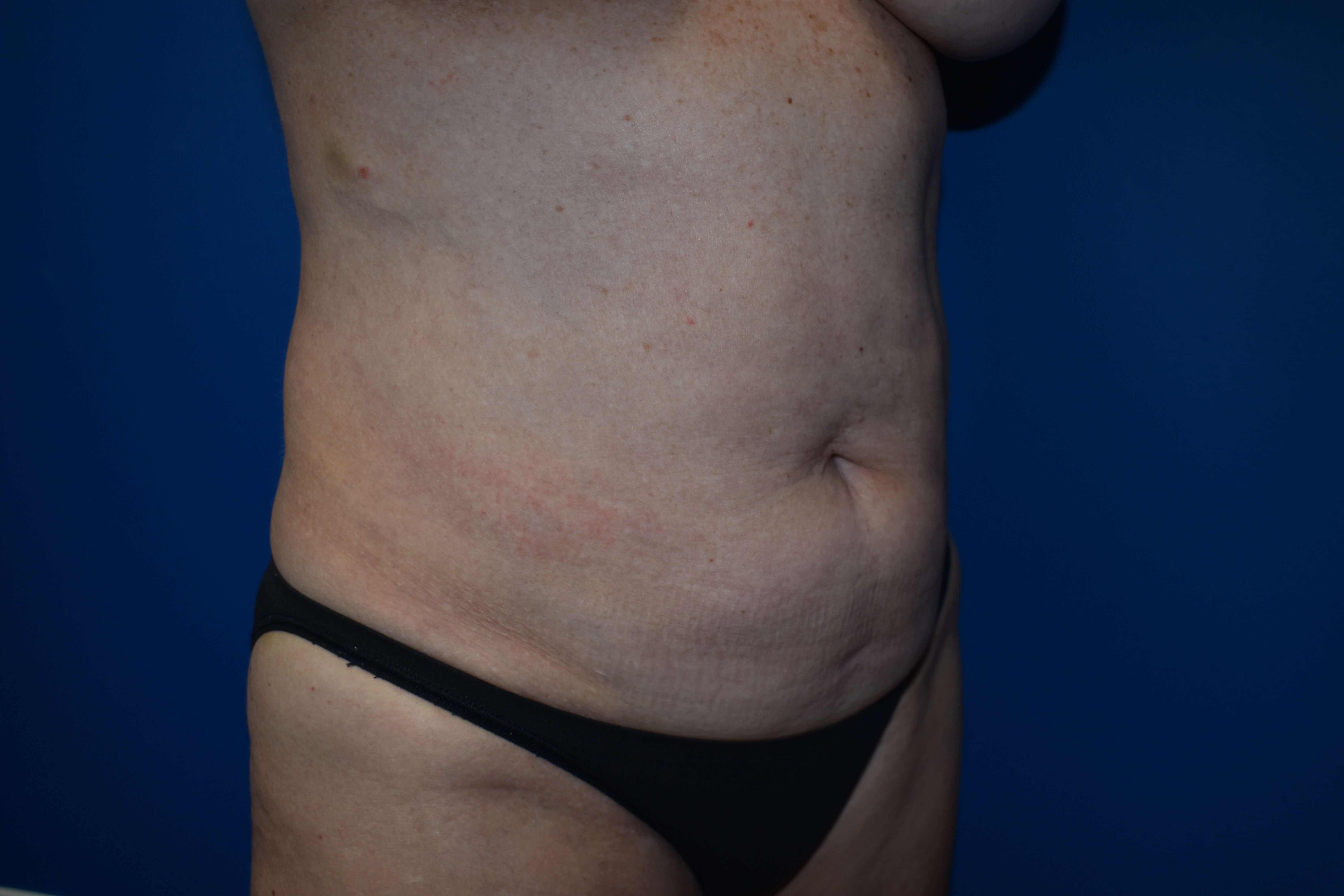 Abdominoplasty with Vaser Lipo Before