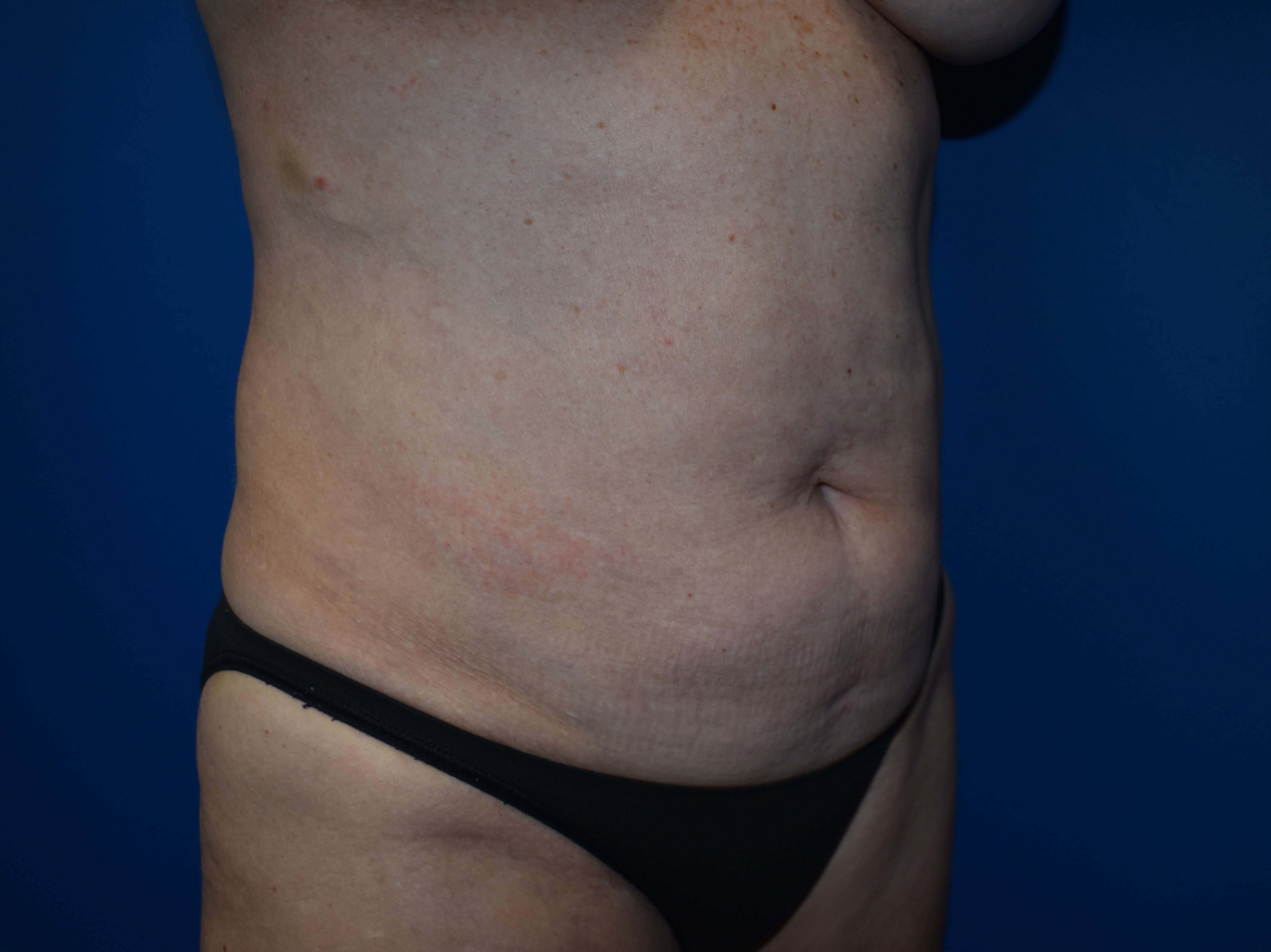 Abdominoplasty with Vaser Lipo Before
