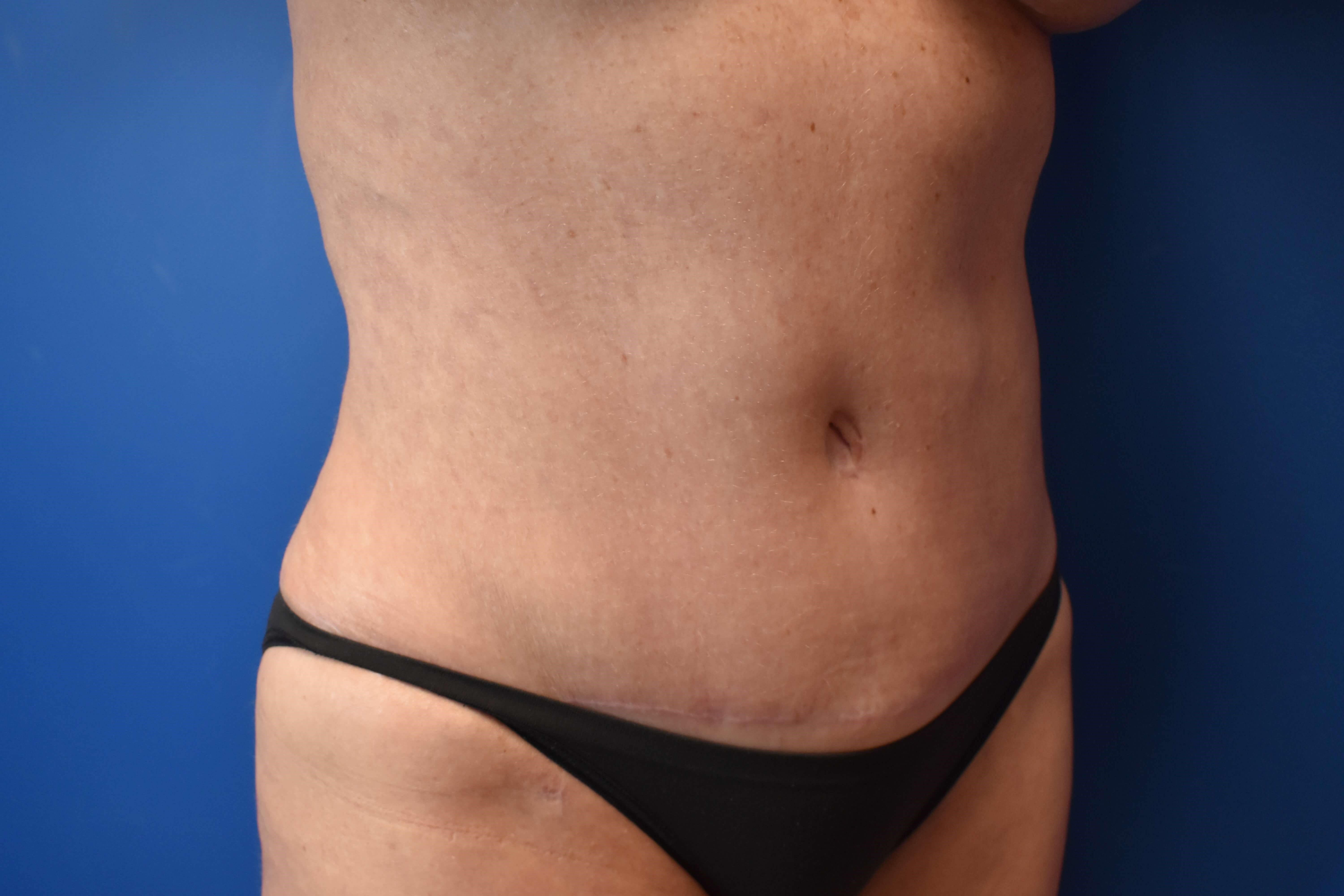 Abdominoplasty with Vaser Lipo After