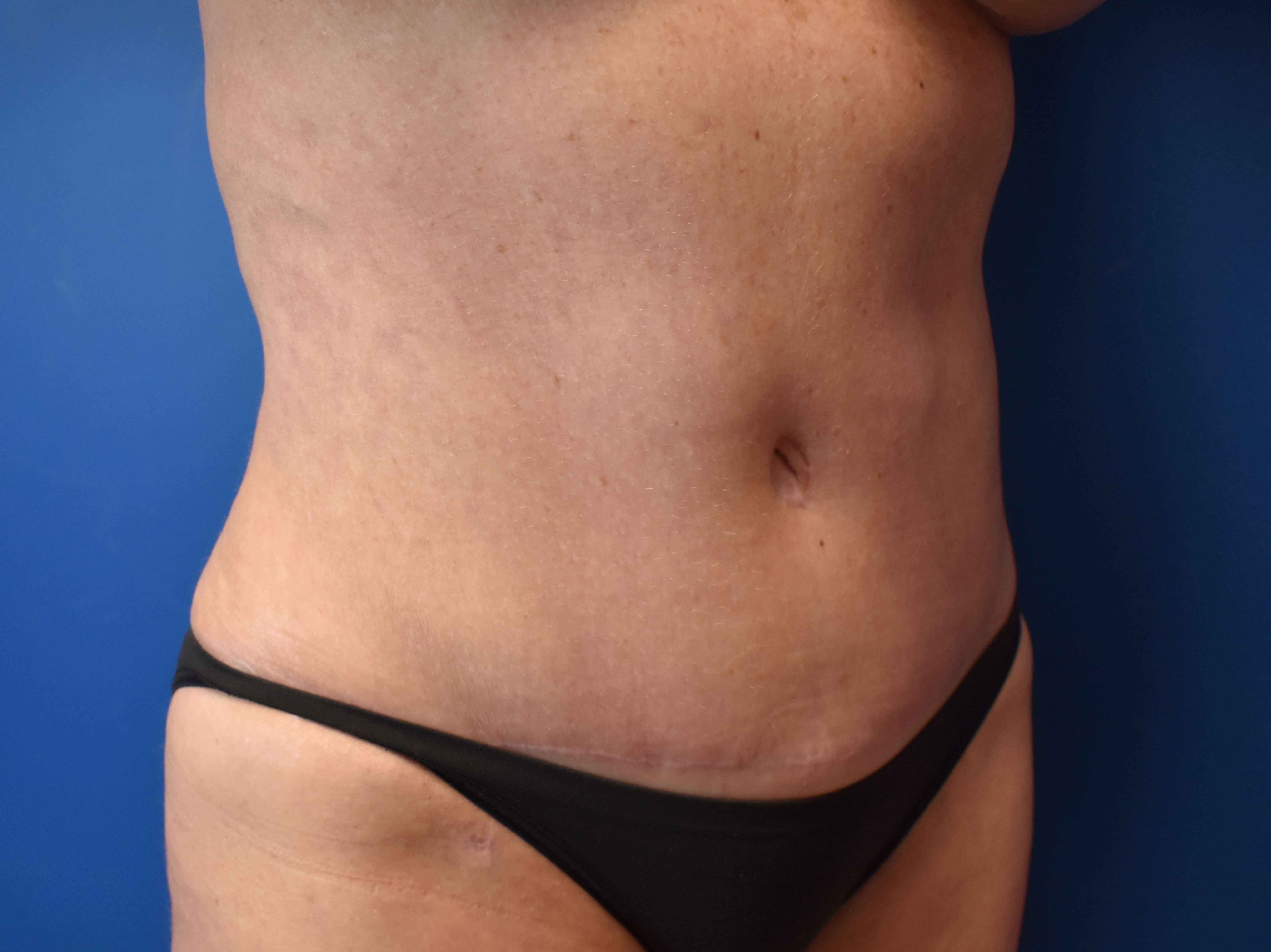 Abdominoplasty with Vaser Lipo After