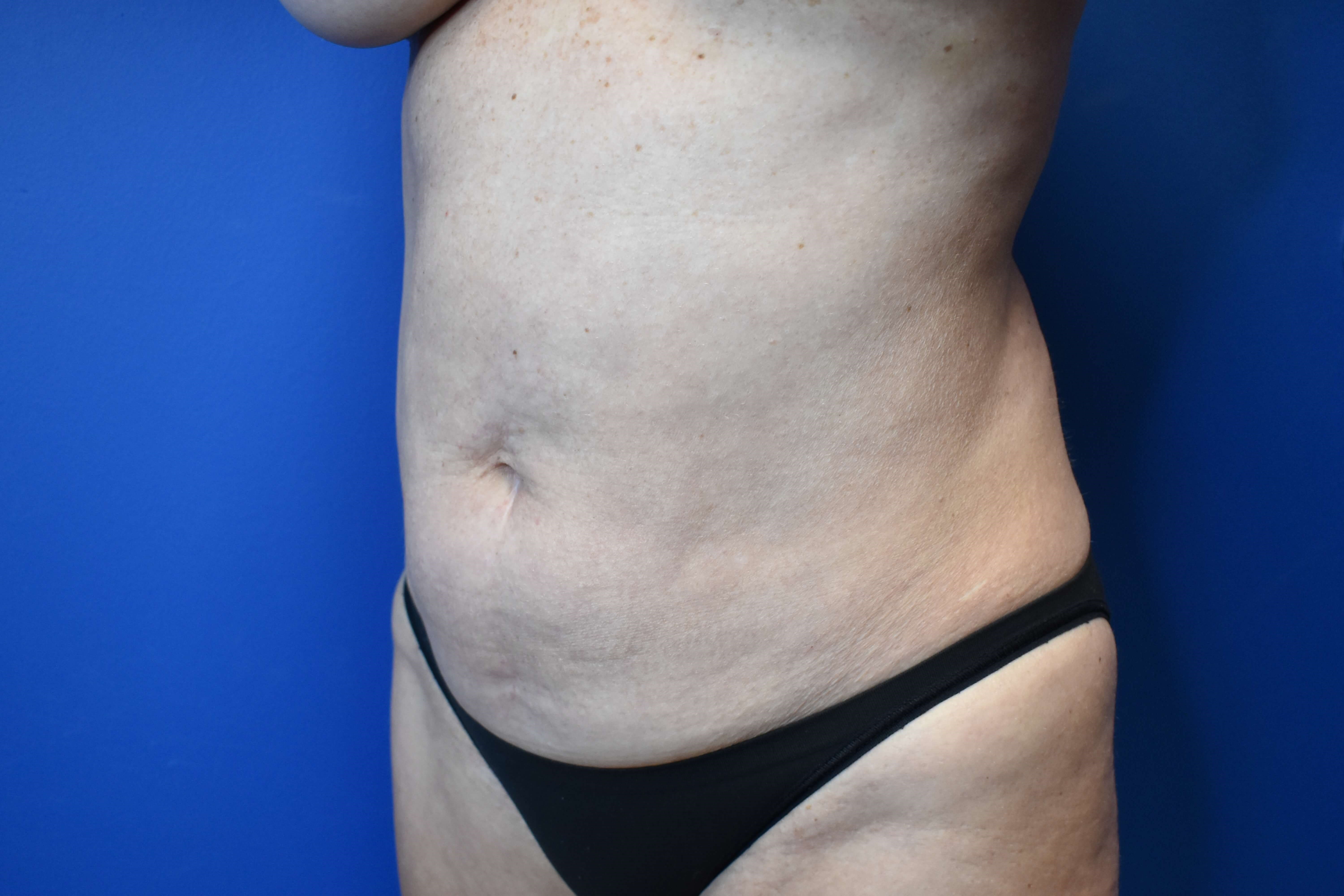 Abdominoplasty with Vaser Lipo Before