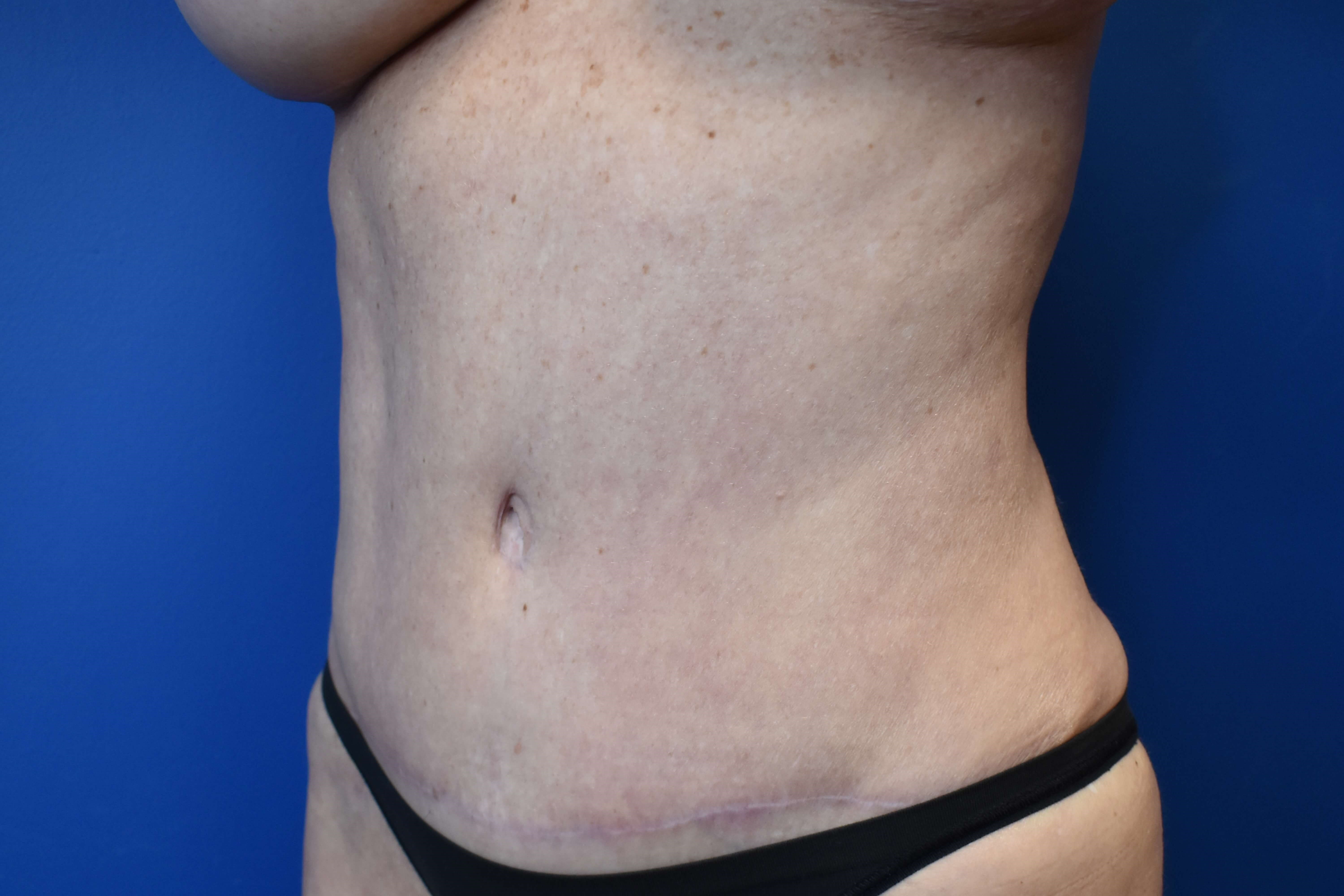 Abdominoplasty with Vaser Lipo After