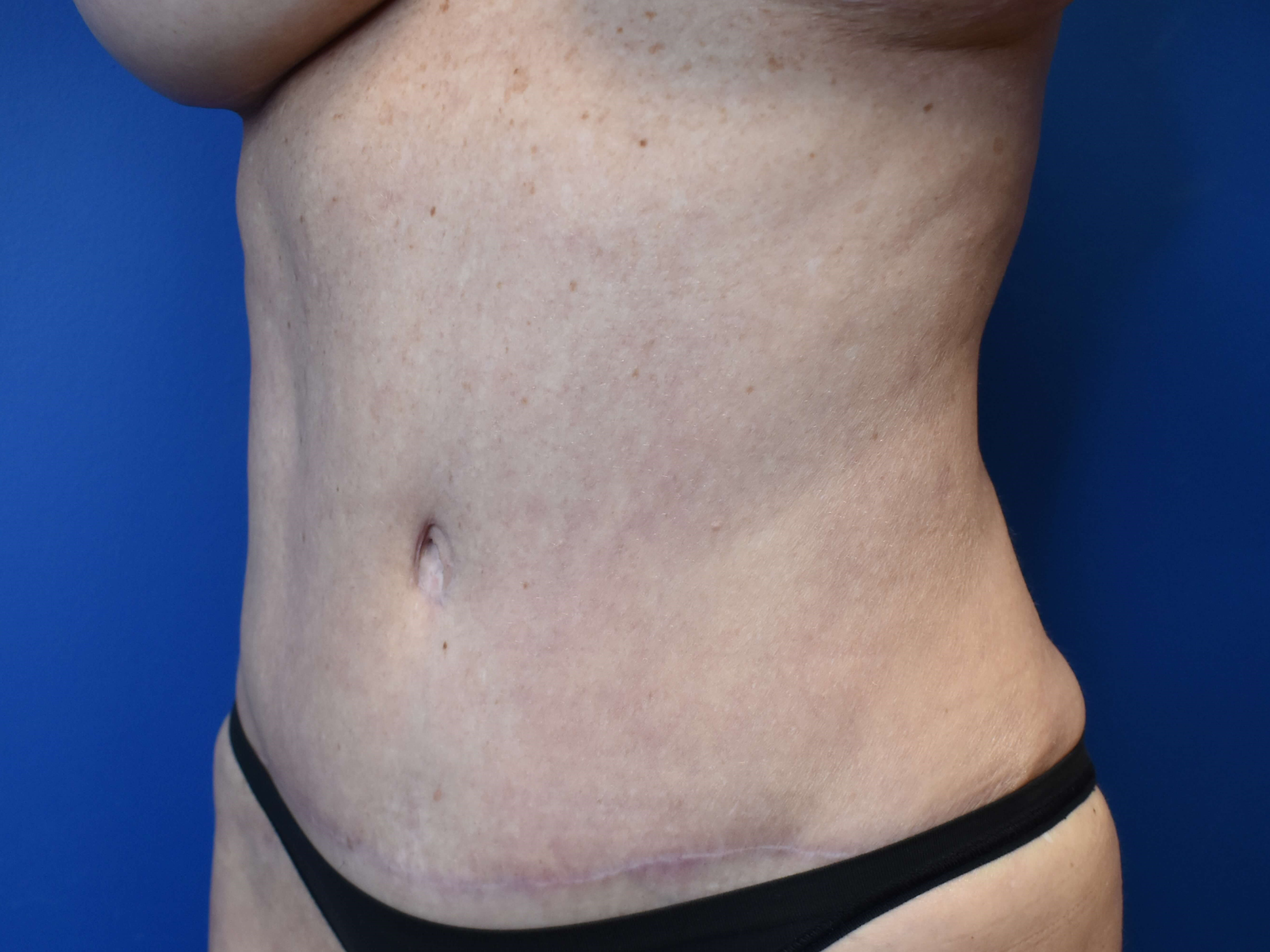 Abdominoplasty with Vaser Lipo After