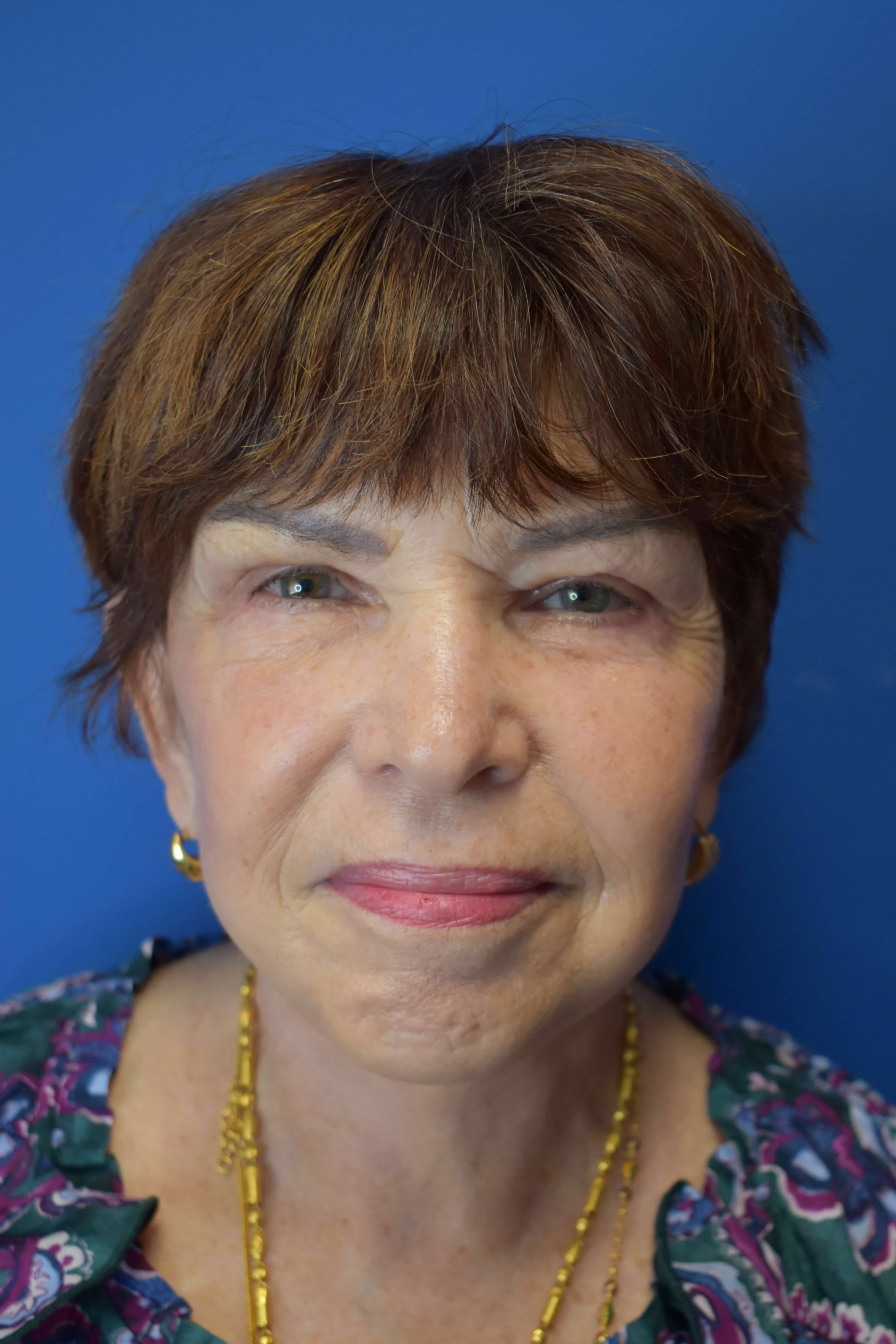 Neck Lift and Vaser Lipo After