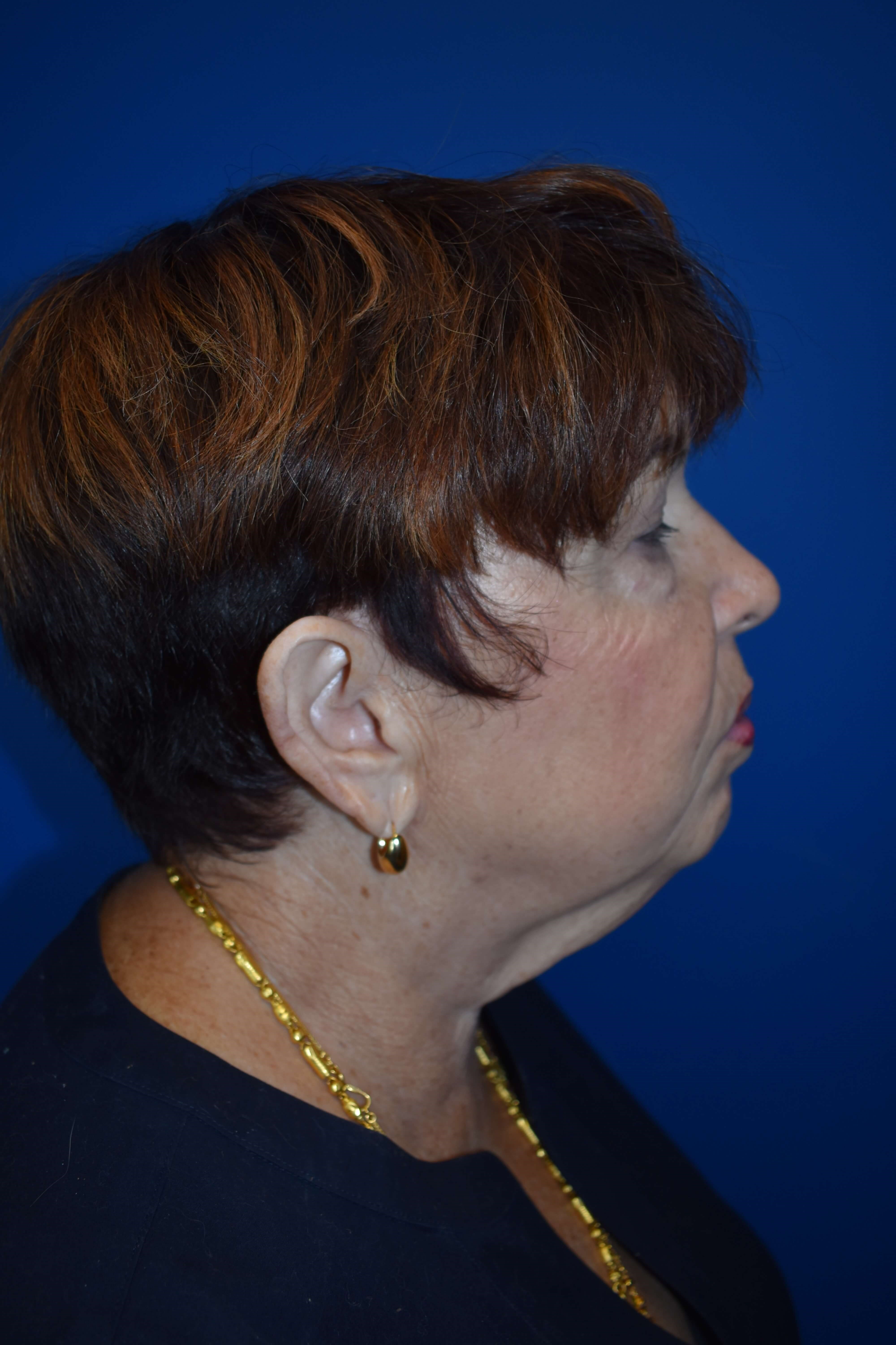 Neck lift and Vaser Lipo Before