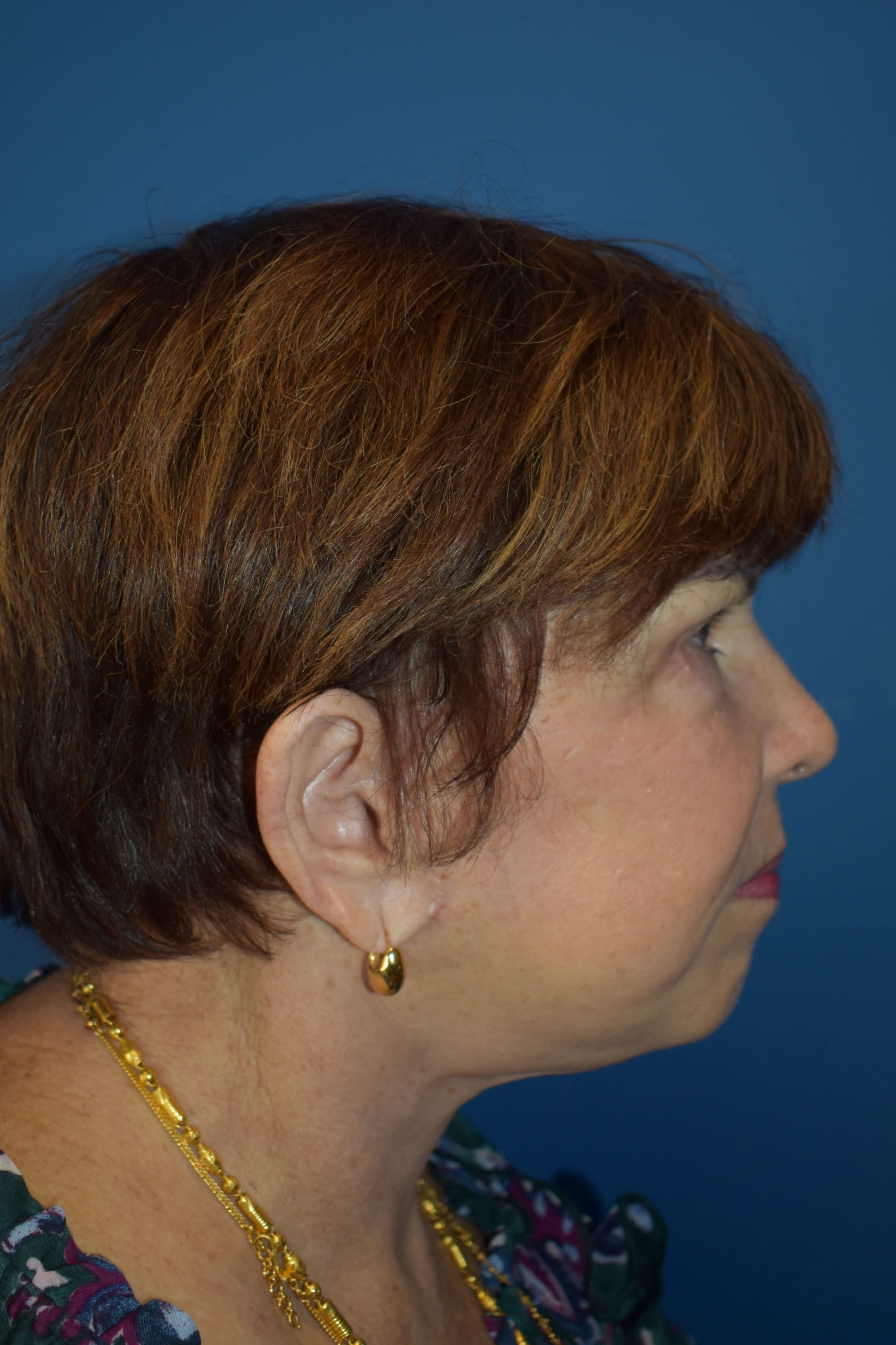 Neck lift and Vaser Lipo After