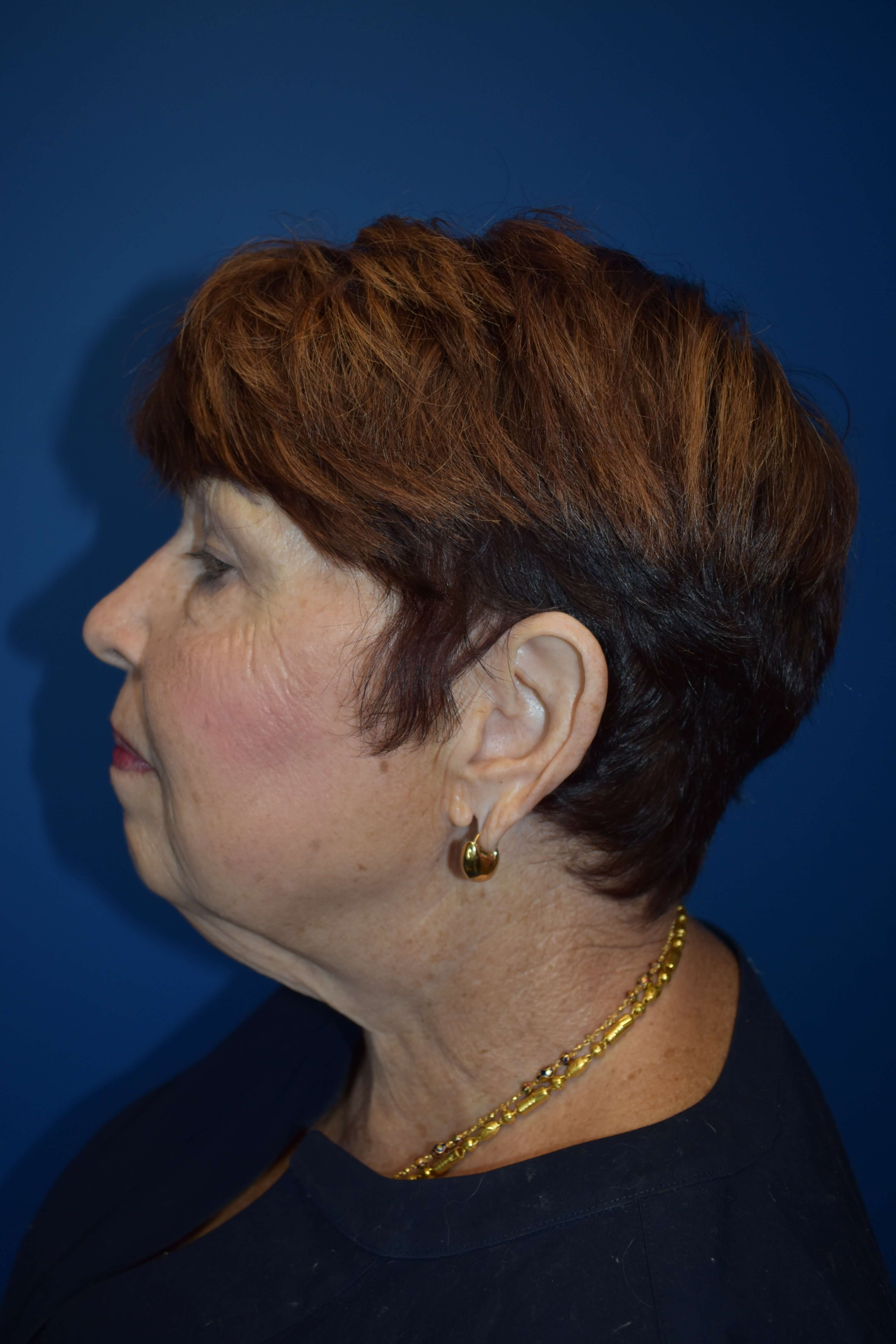 Neck Lift and Vaser Lipo Before