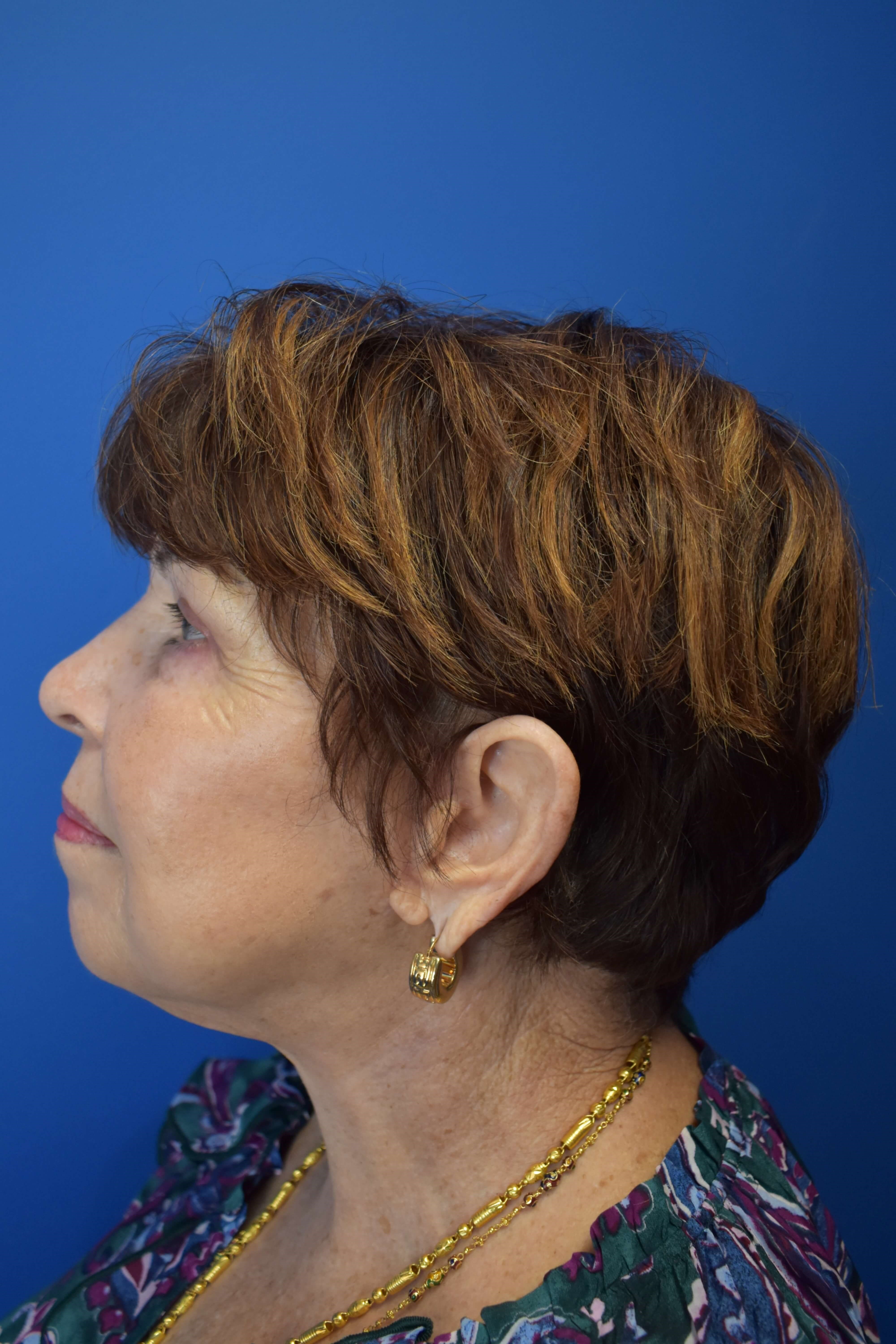 Neck Lift and Vaser Lipo After