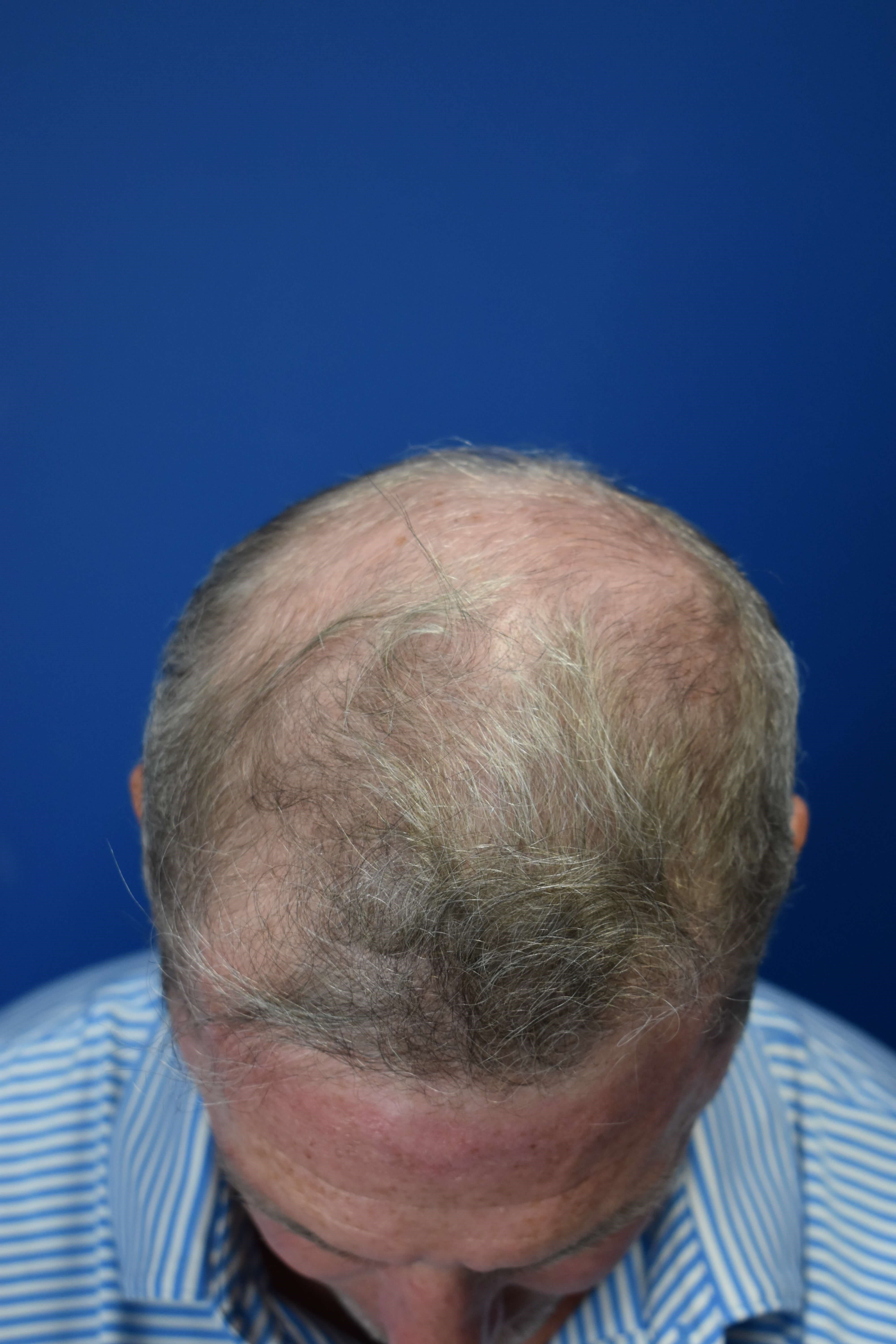 FUT Hair Restoration Before