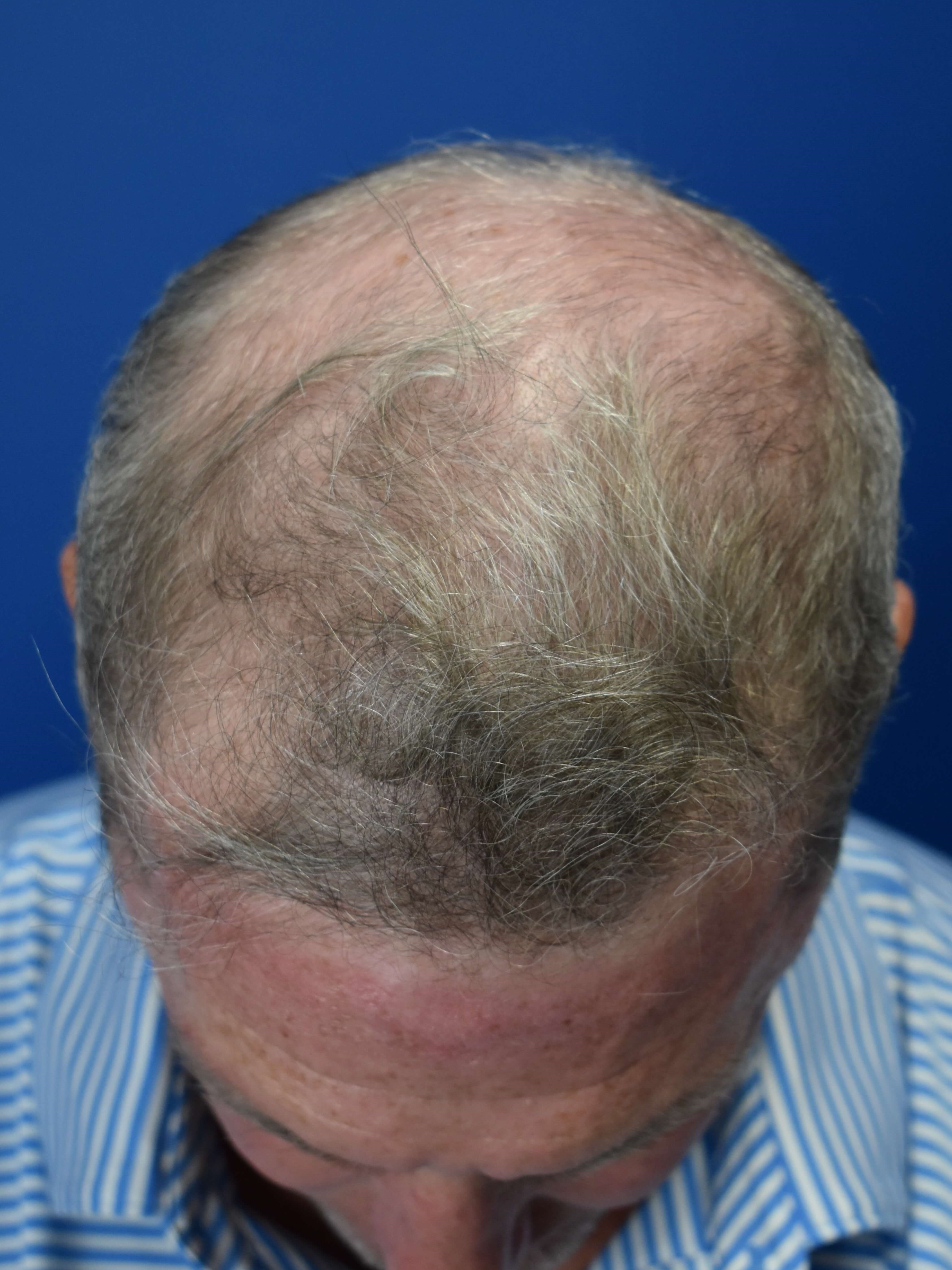 FUT Hair Restoration Before