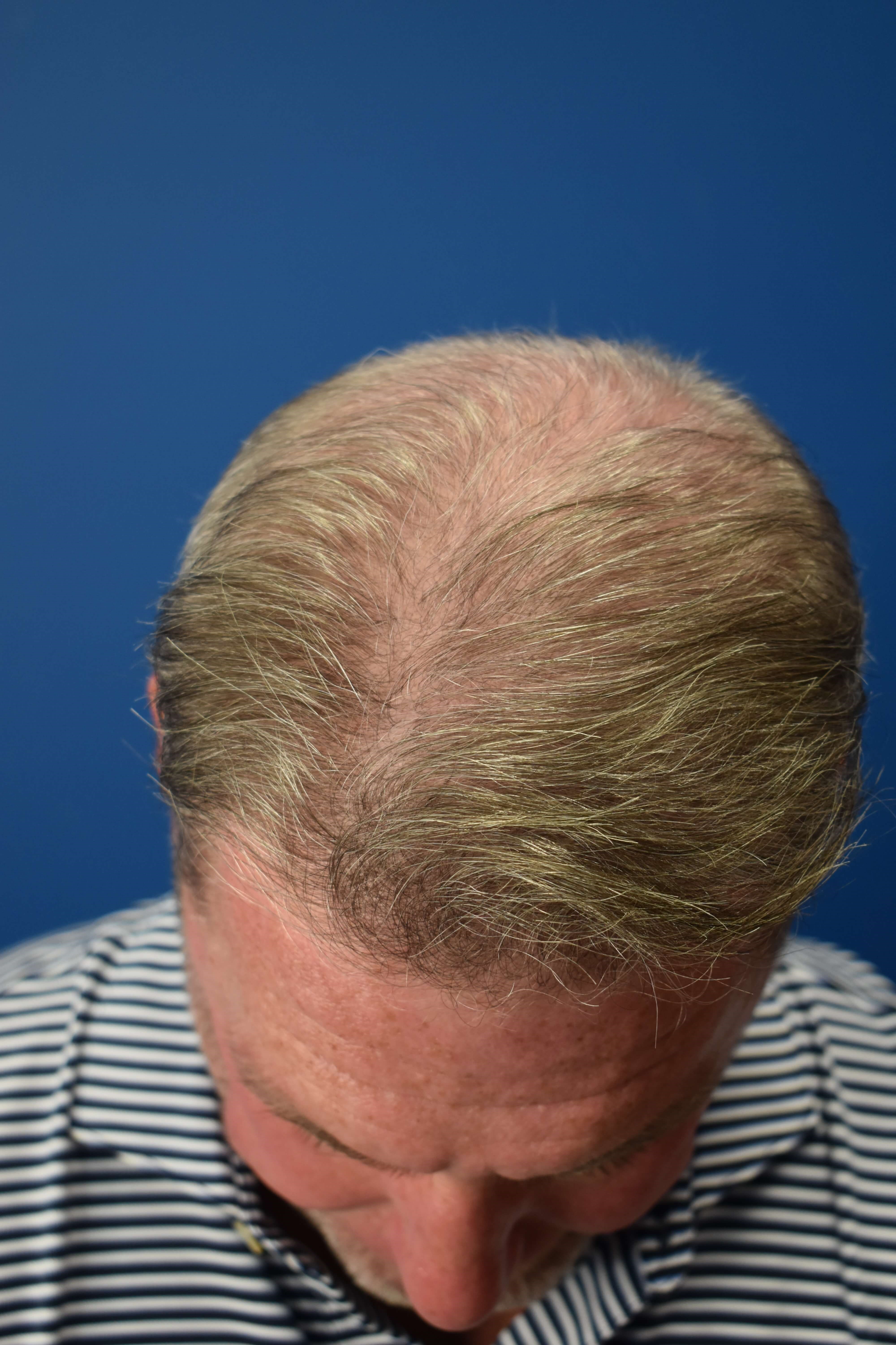 FUT Hair Restoration After
