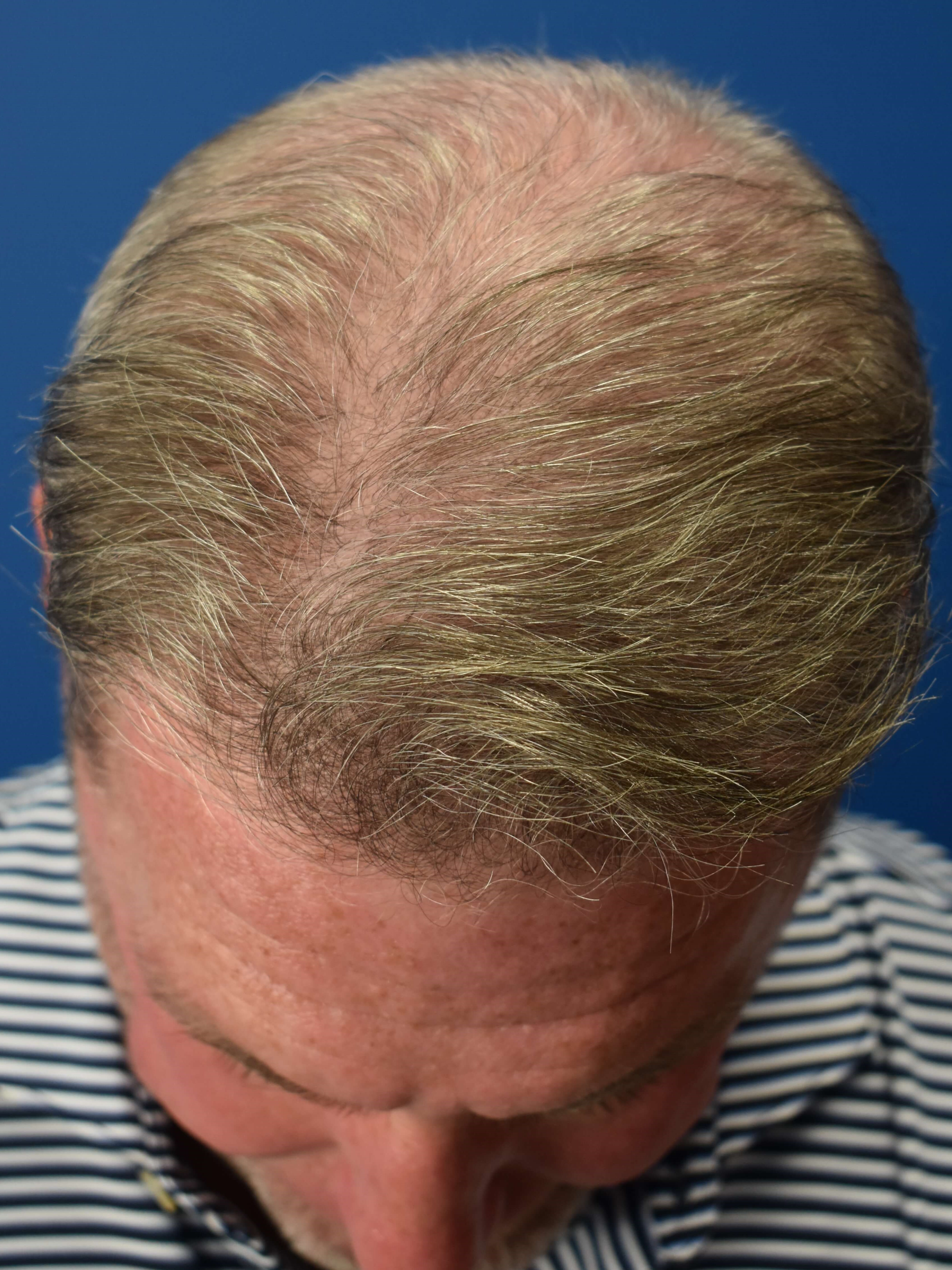 FUT Hair Restoration After