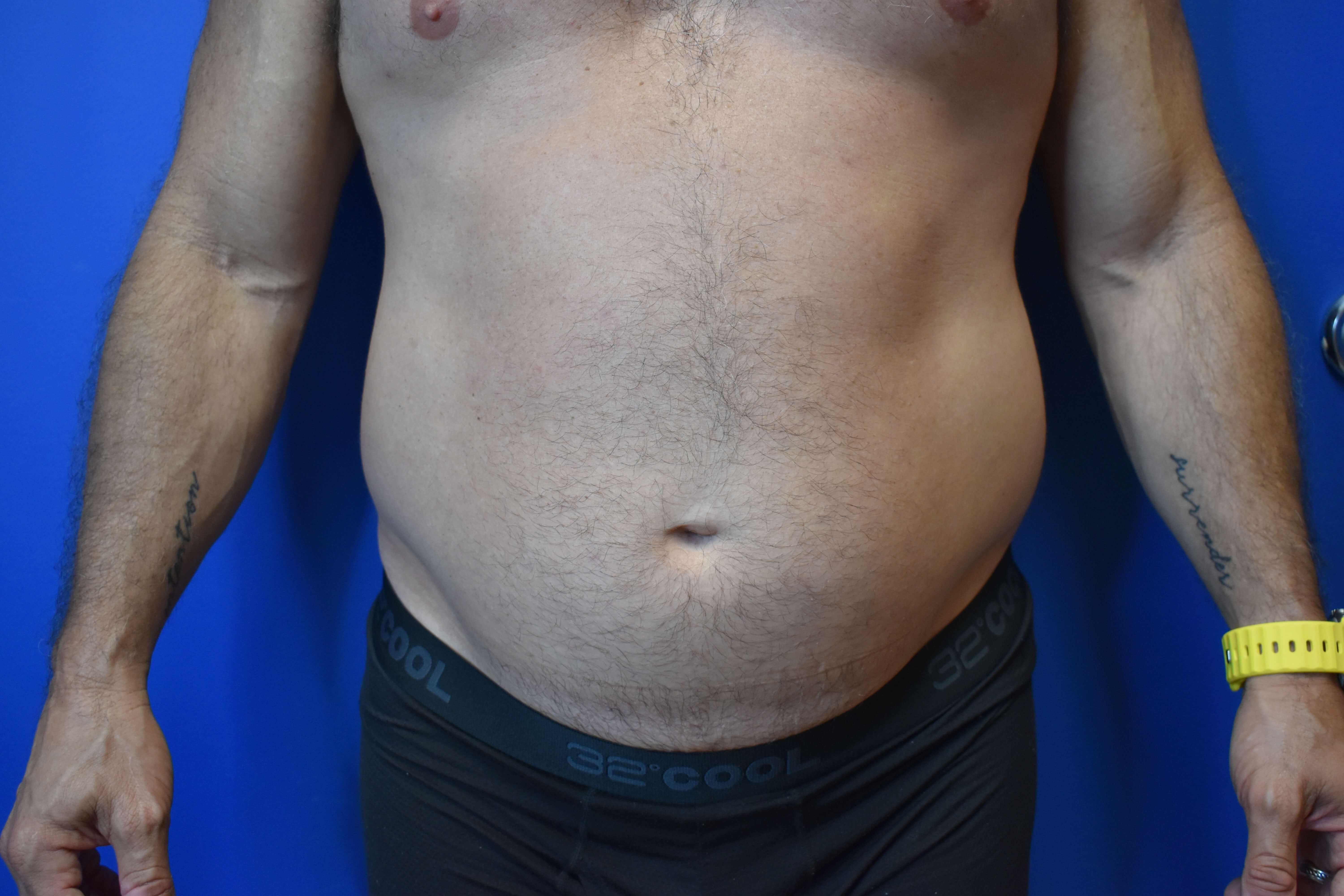 VASER lipo: Hips and abdomen Before