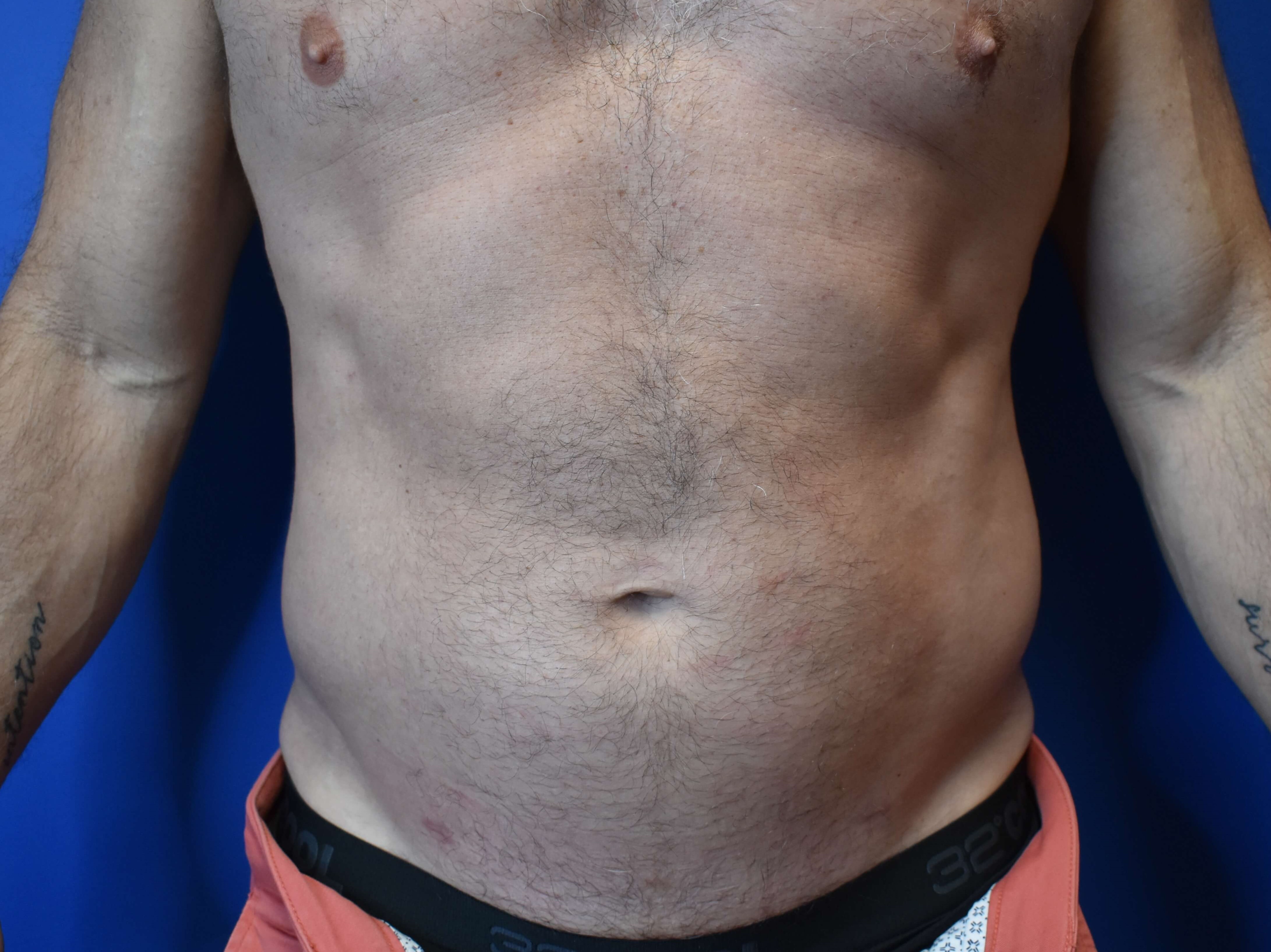 VASER lipo: Hips and abdomen After