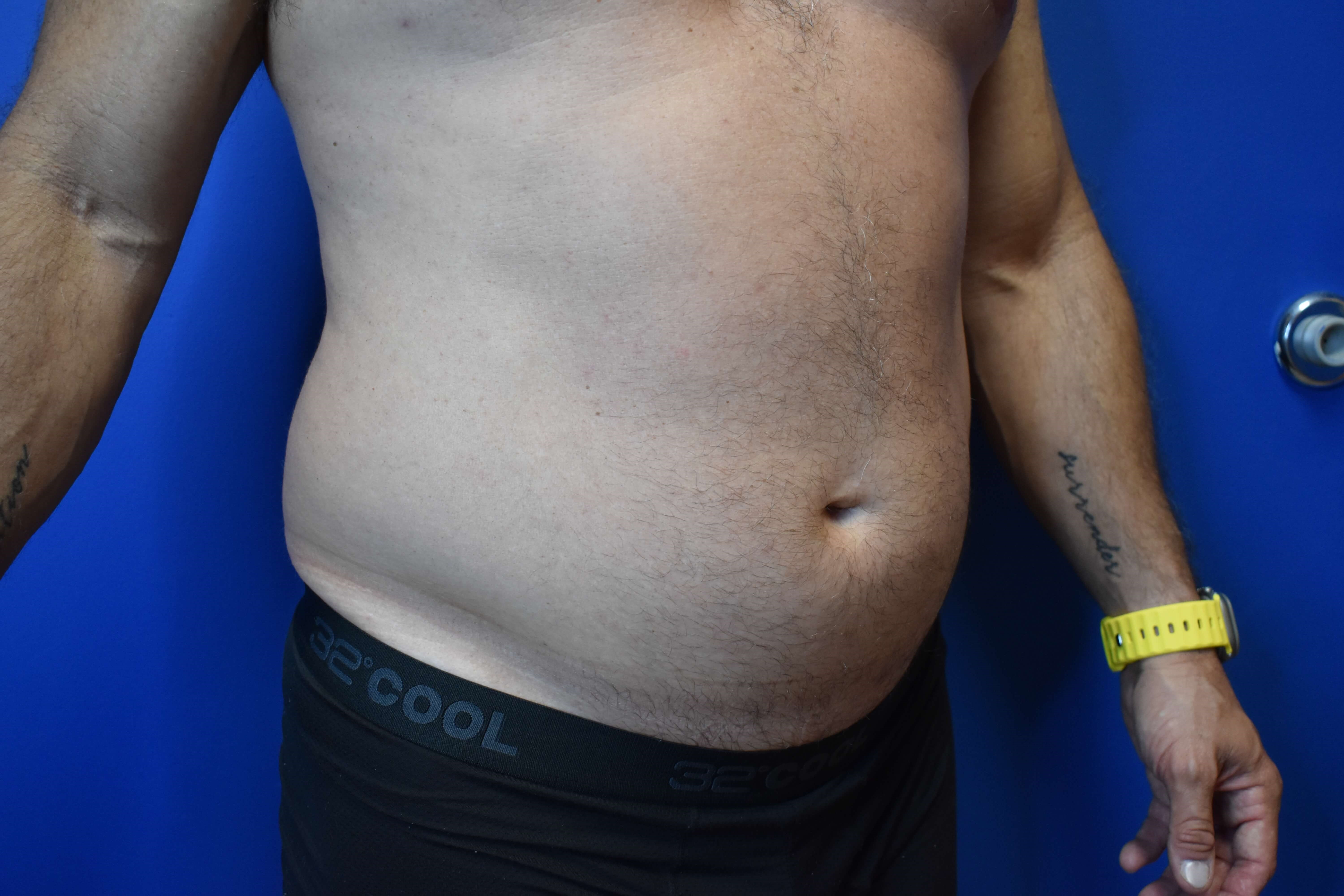 VASER lipo: Hips and abdomen Before