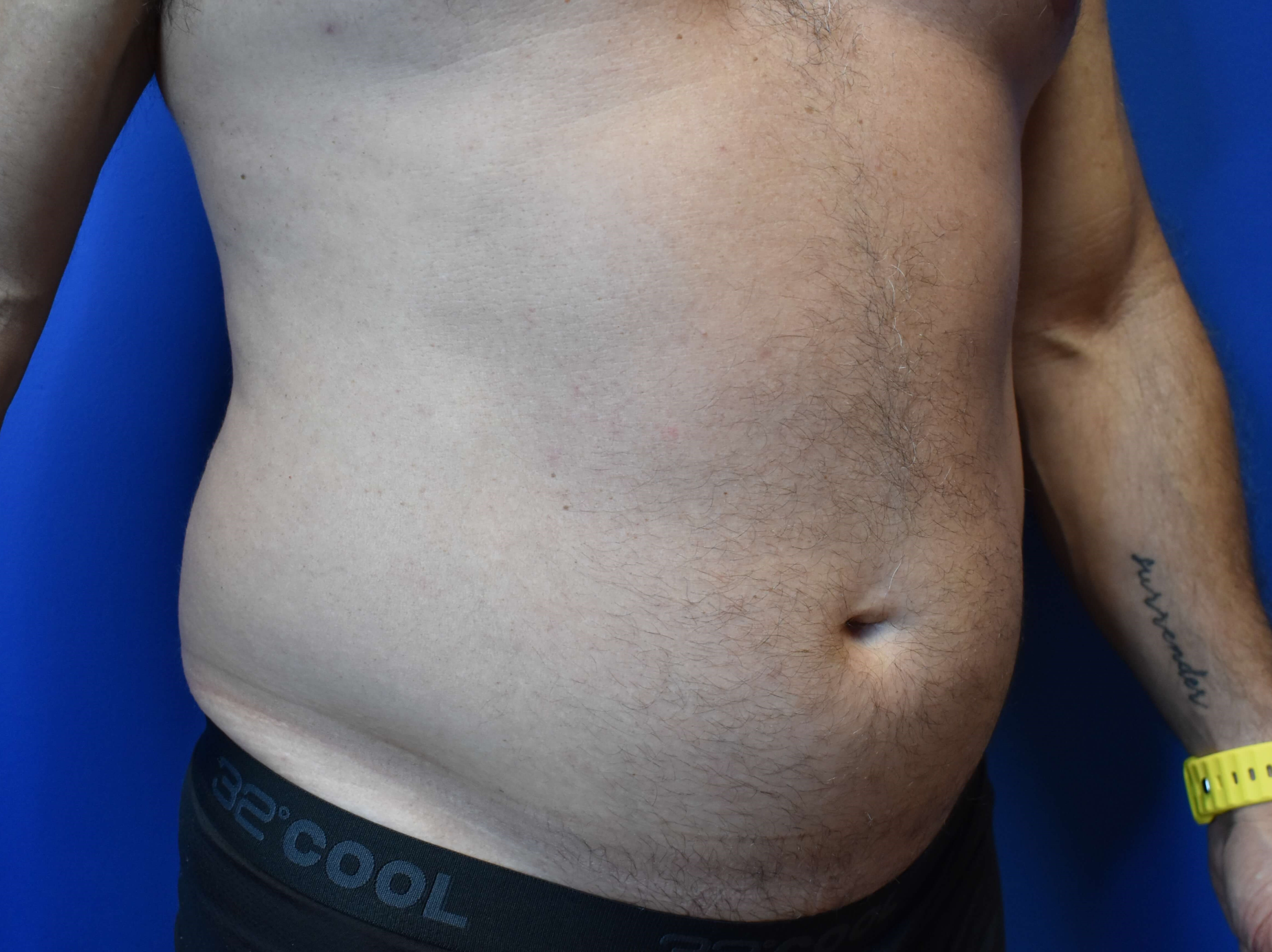 VASER lipo: Hips and abdomen Before