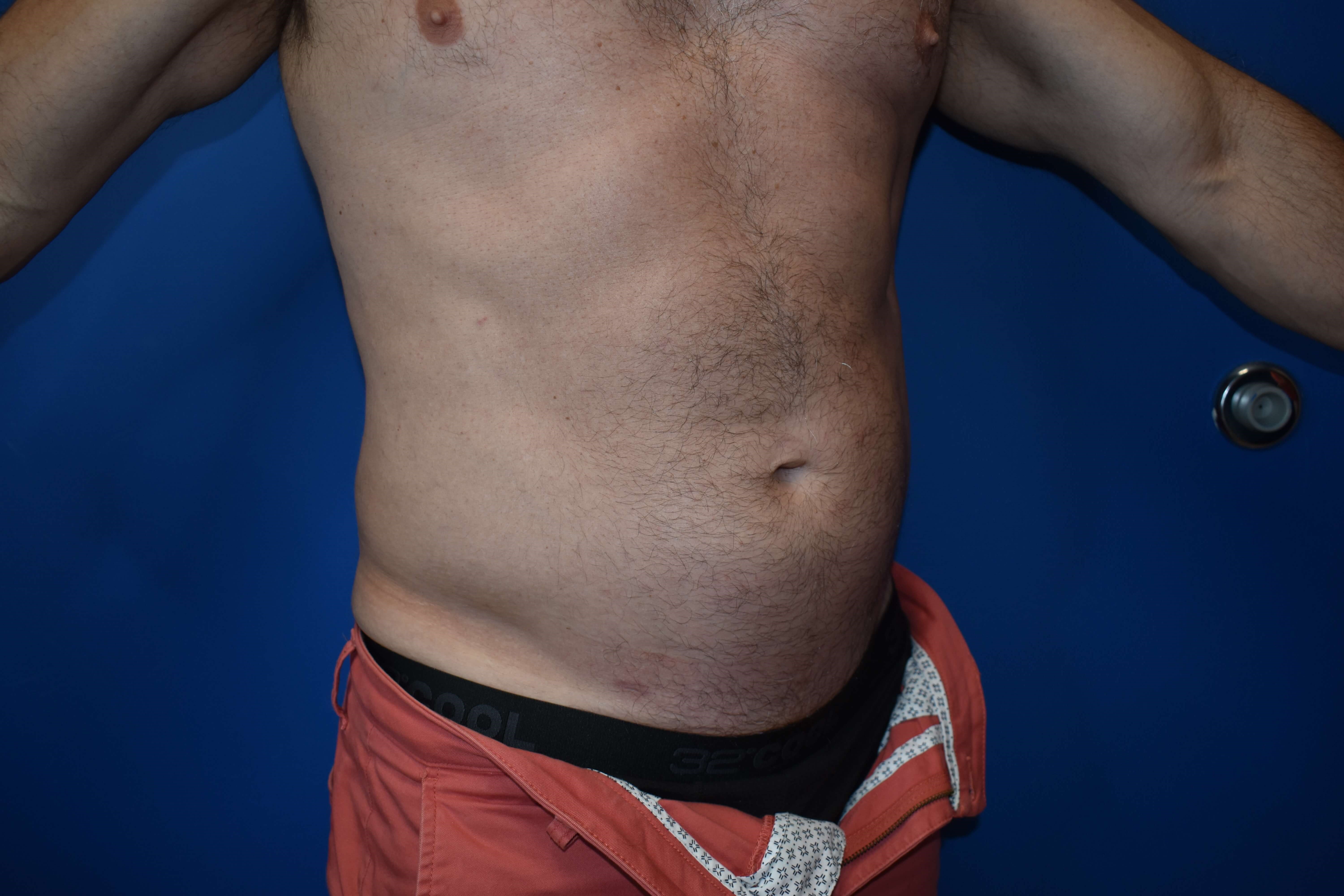 VASER lipo: Hips and abdomen After