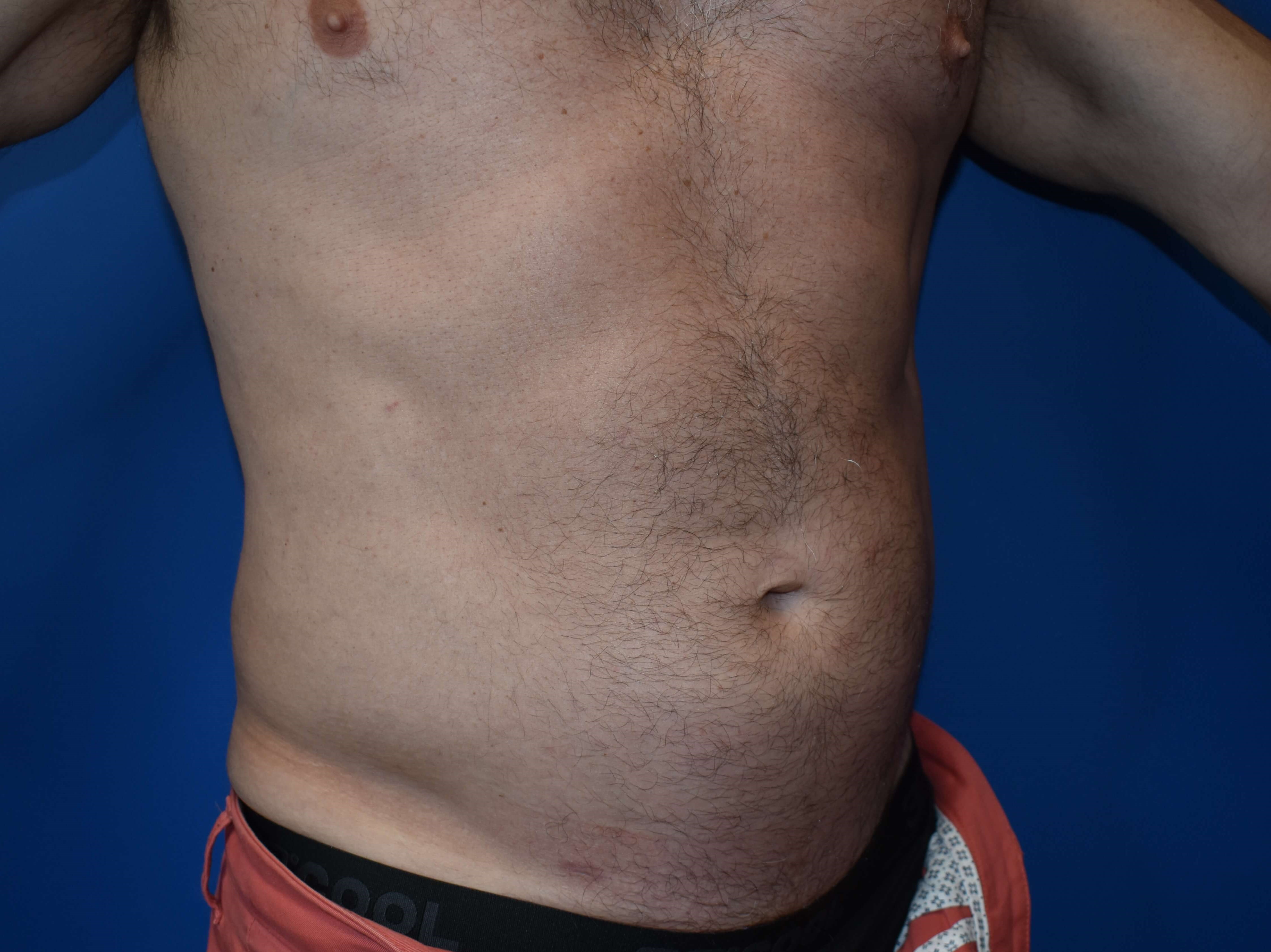 VASER lipo: Hips and abdomen After
