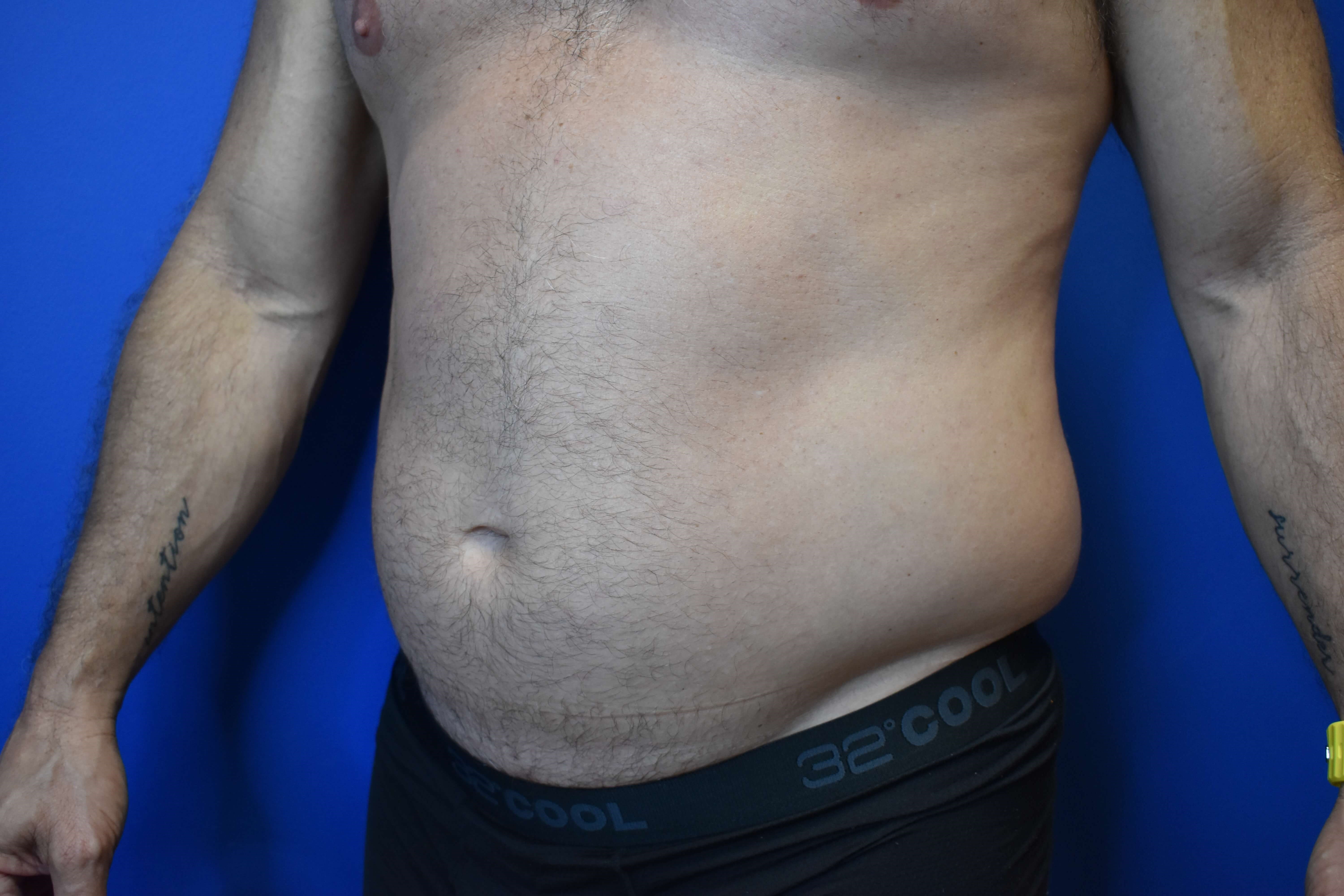 VASER lipo: Hips and abdomen Before