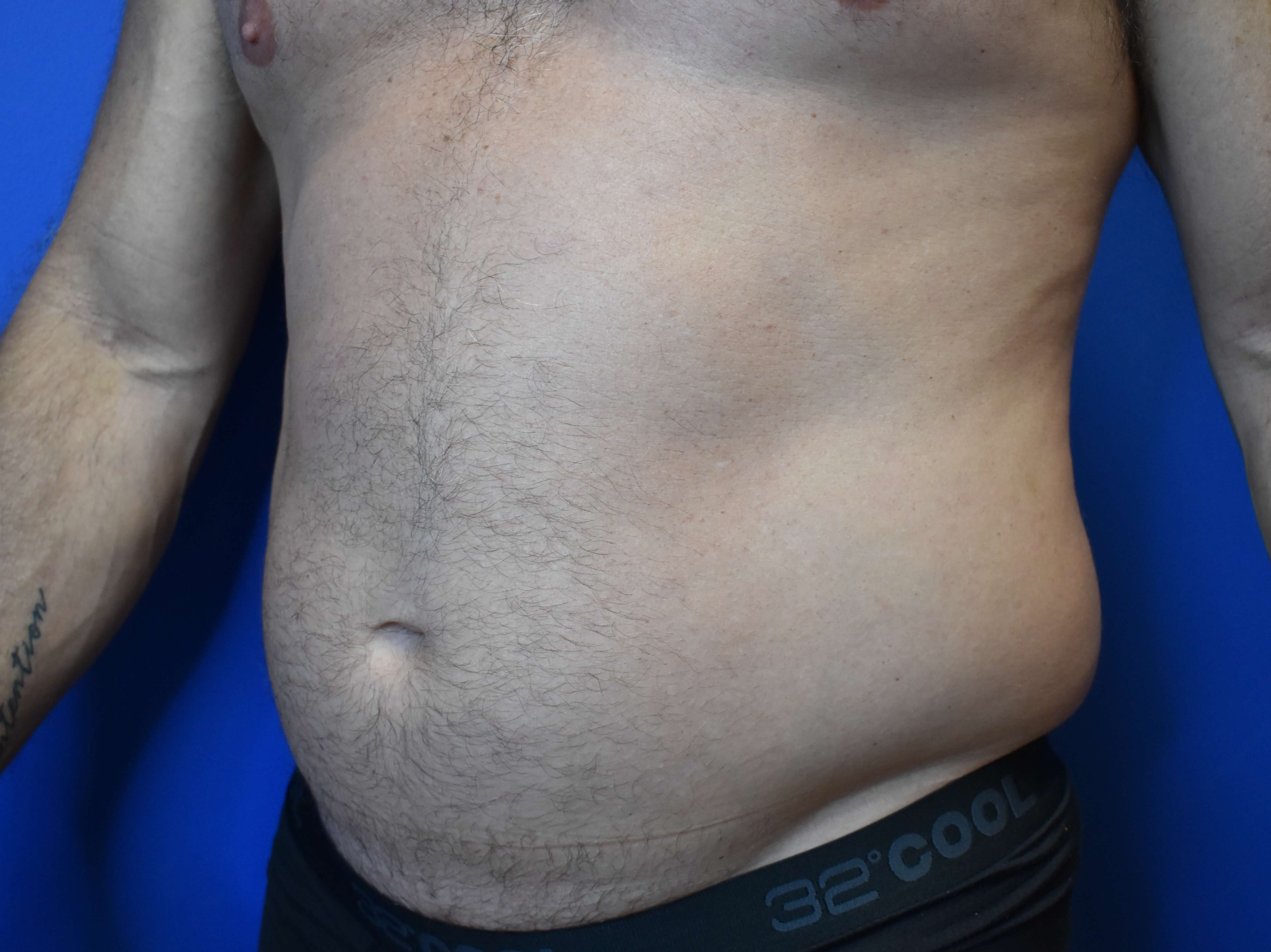VASER lipo: Hips and abdomen Before
