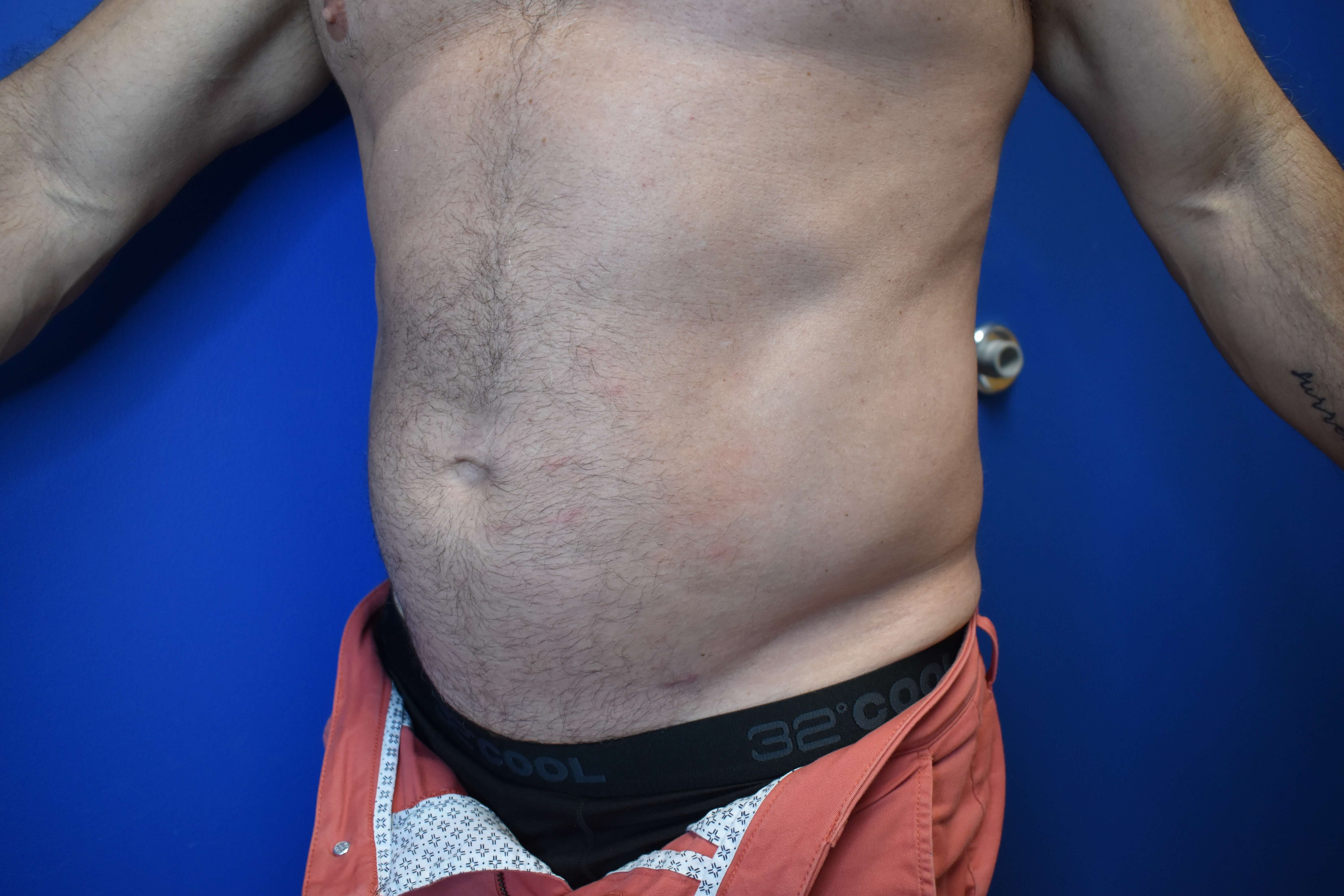 VASER lipo: Hips and abdomen After