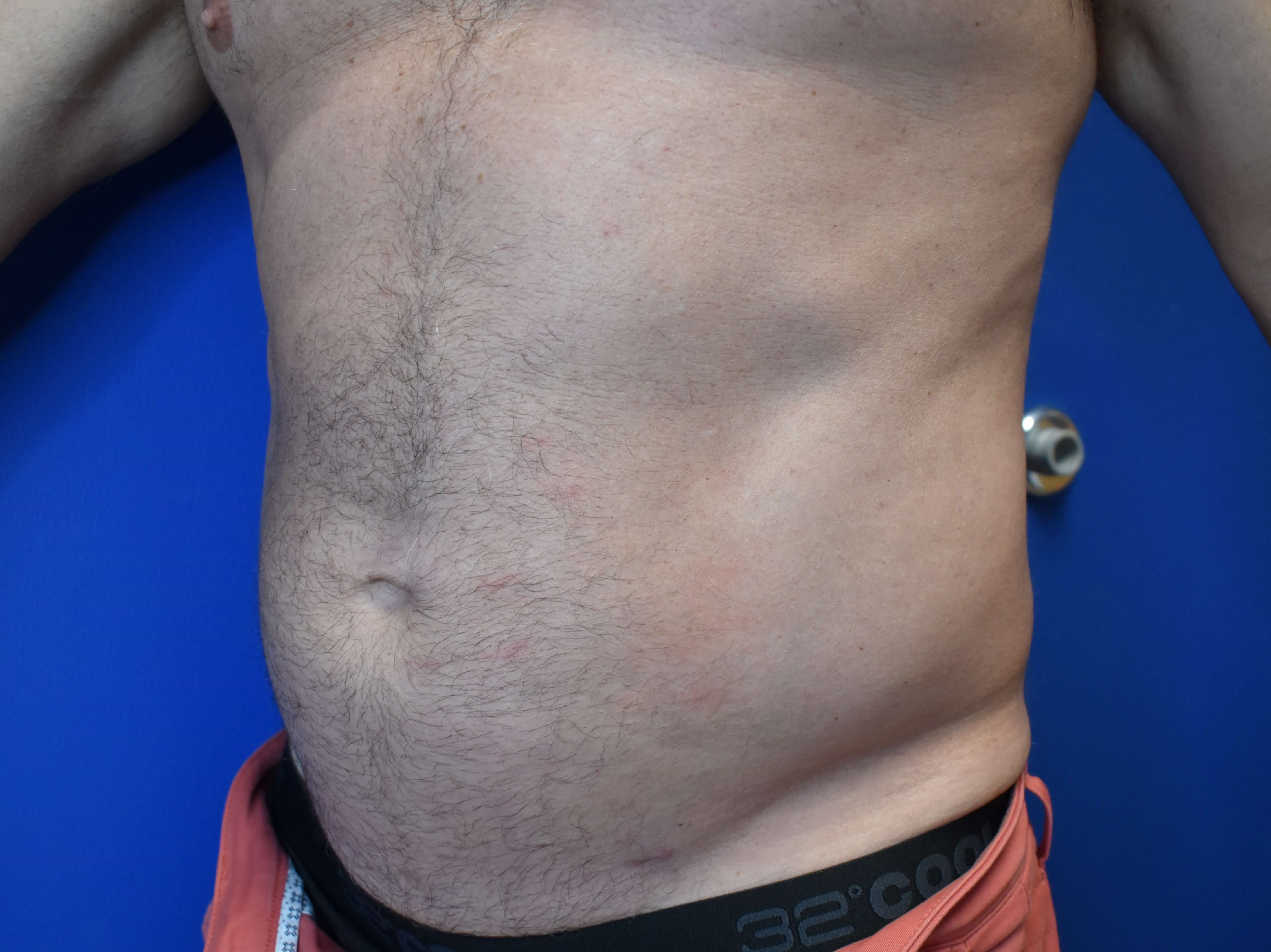 VASER lipo: Hips and abdomen After