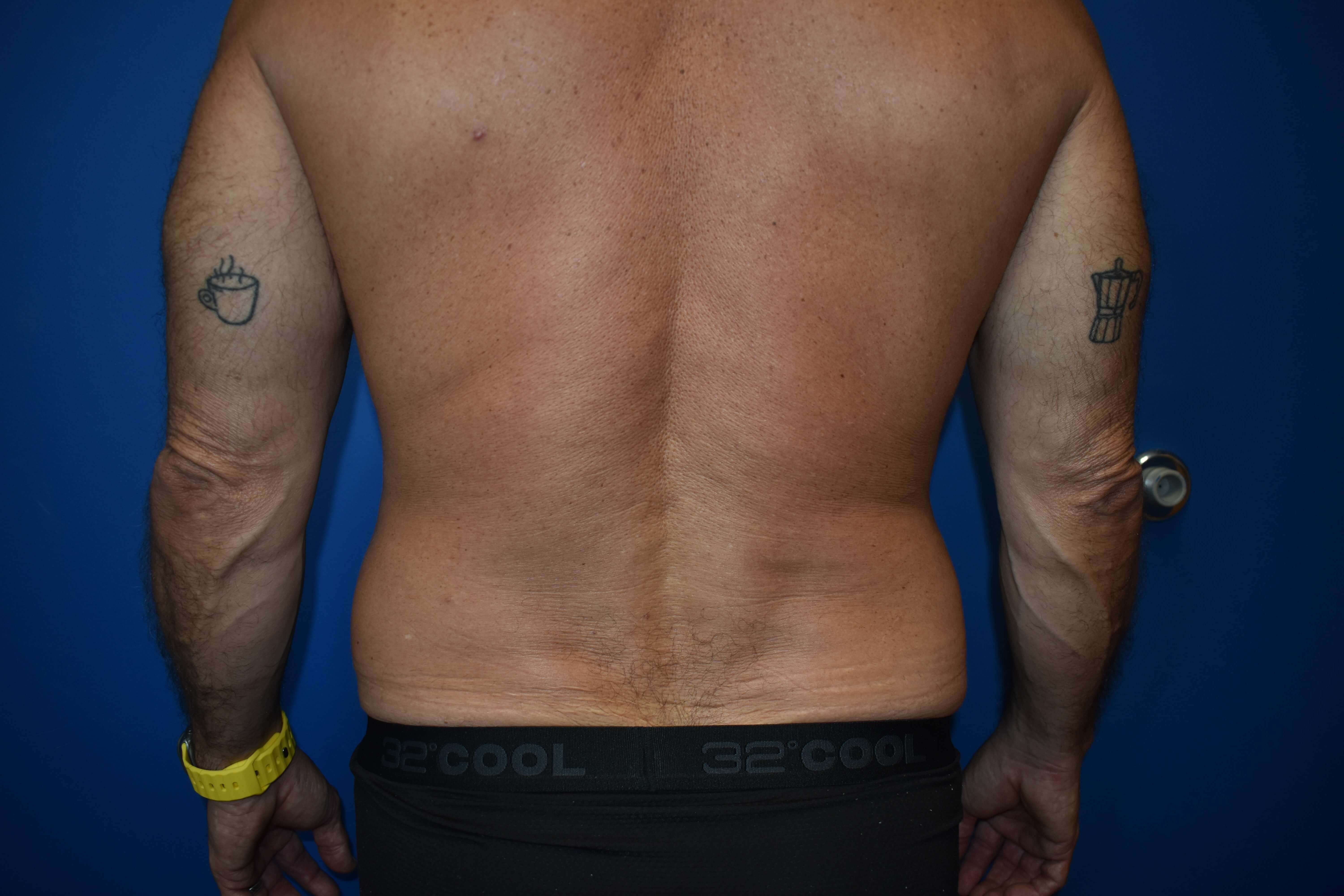 VASER lipo: Hips and abdomen Before