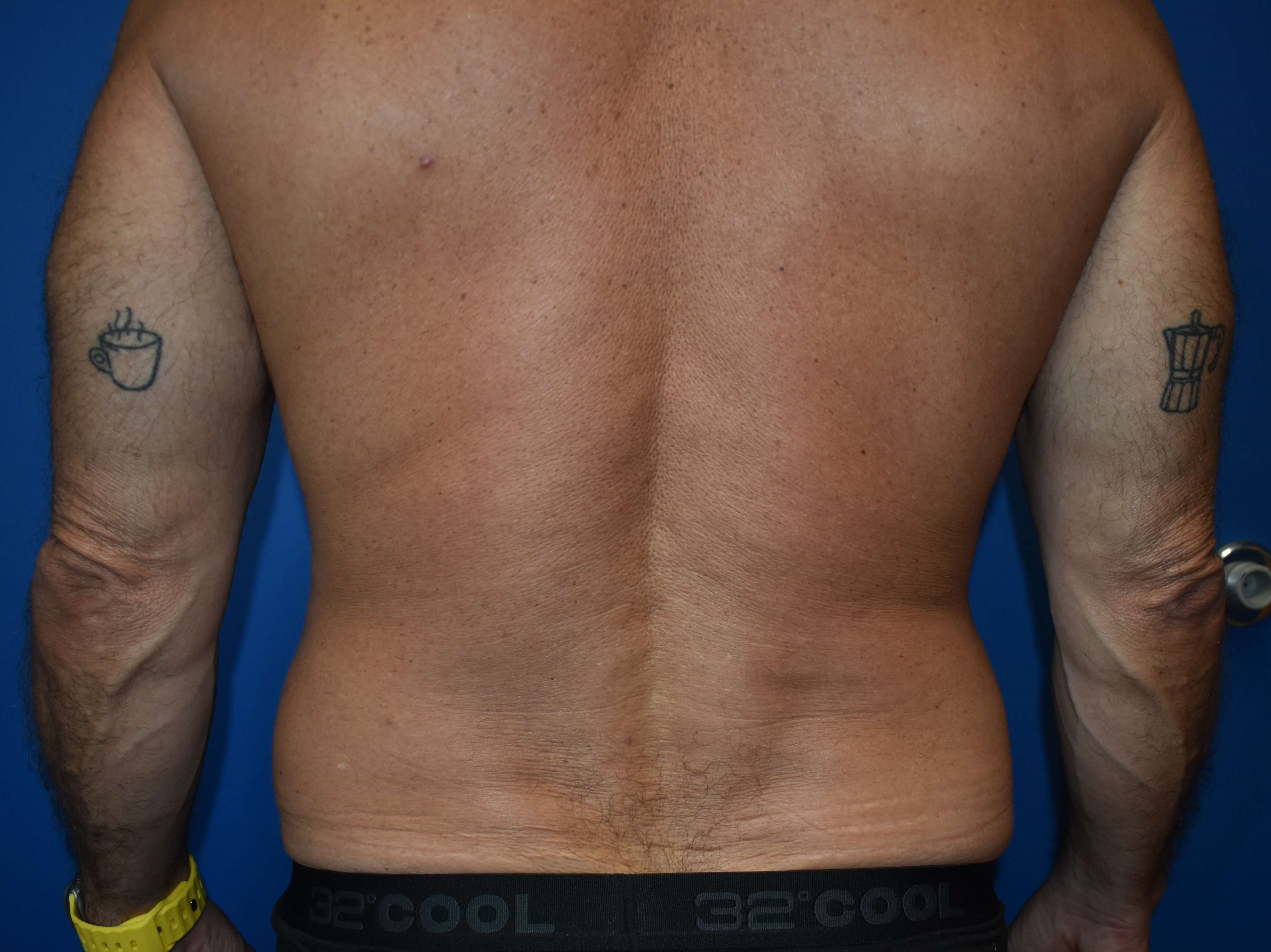 VASER lipo: Hips and abdomen Before