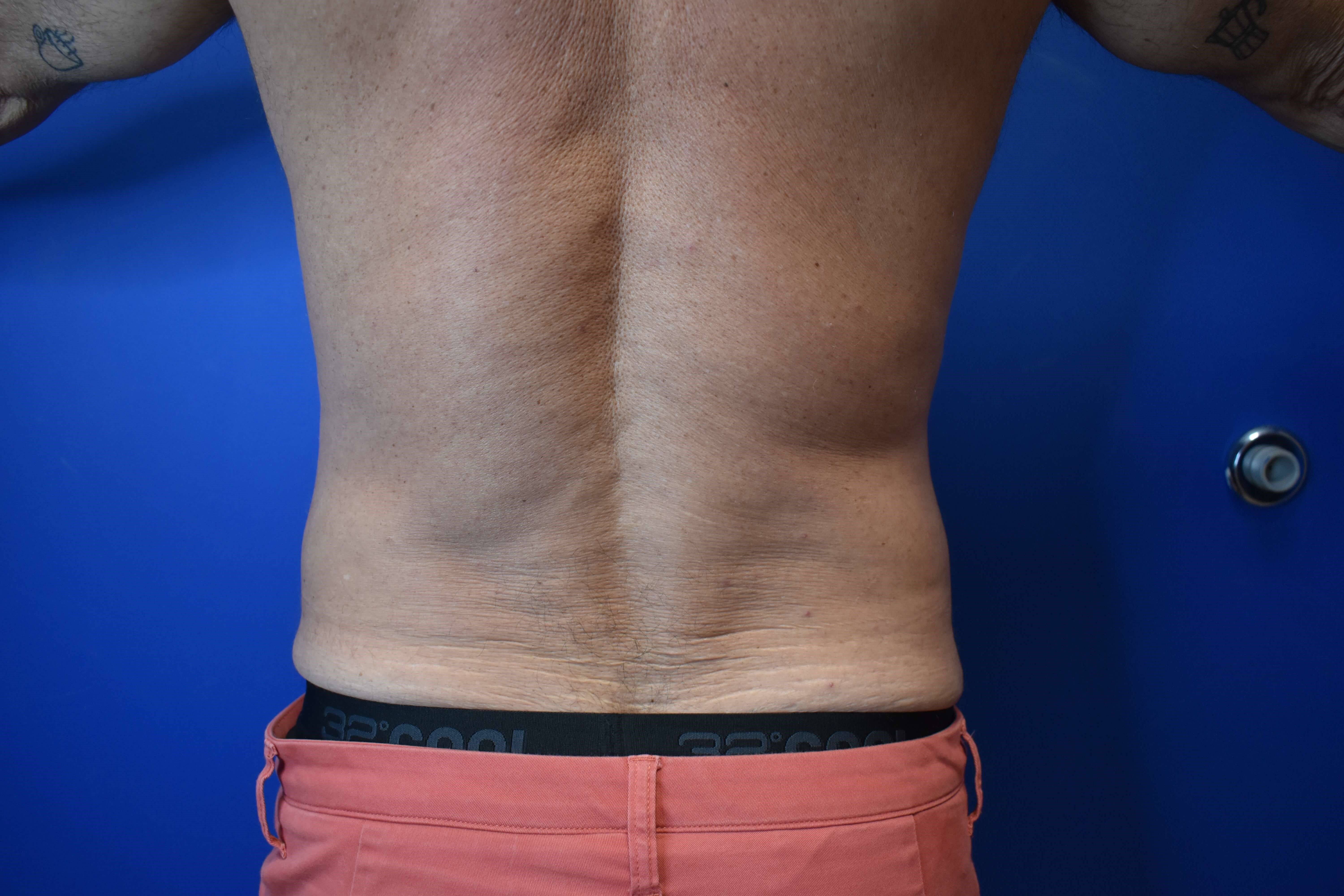 VASER lipo: Hips and abdomen After