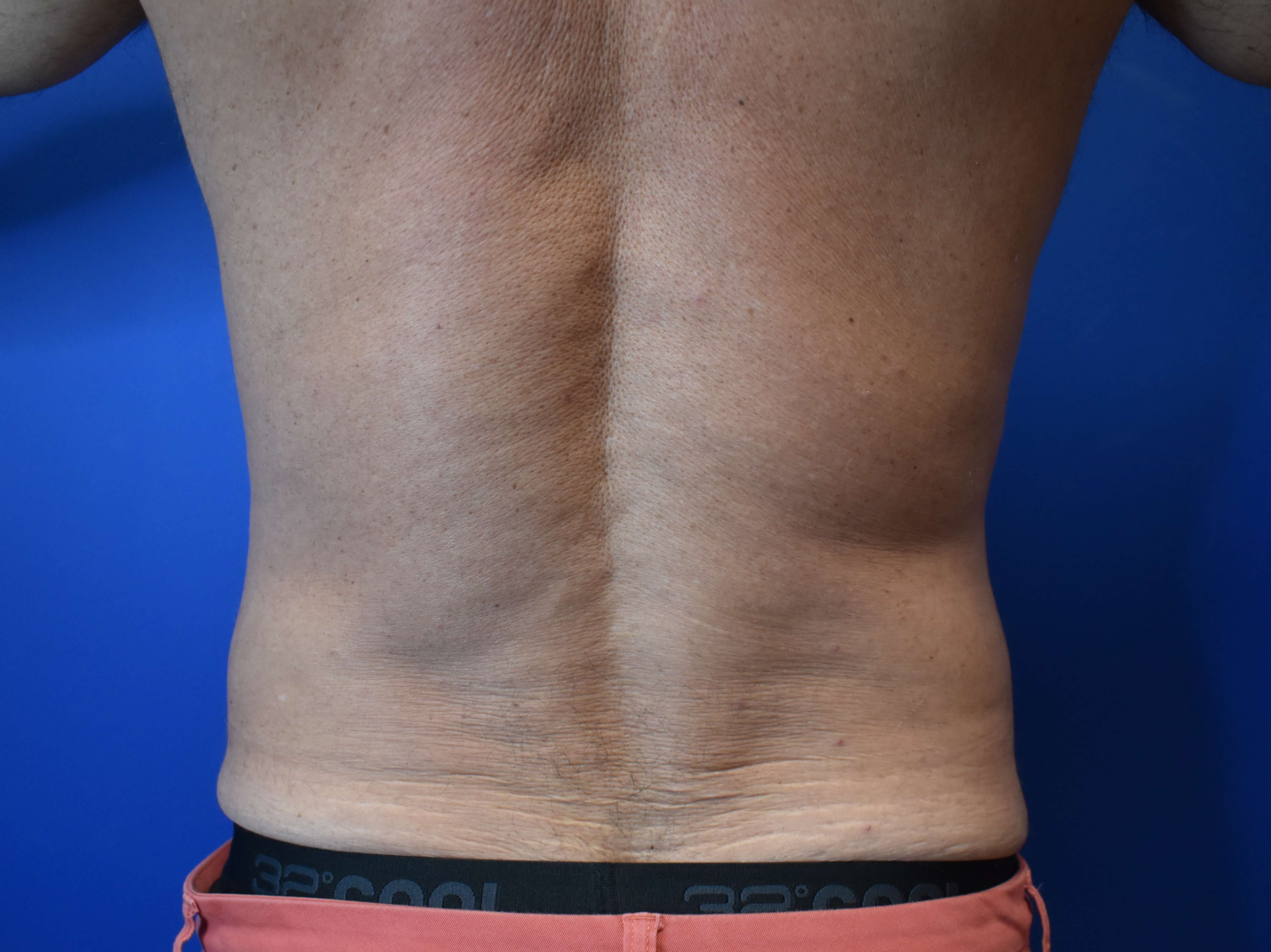 VASER lipo: Hips and abdomen After