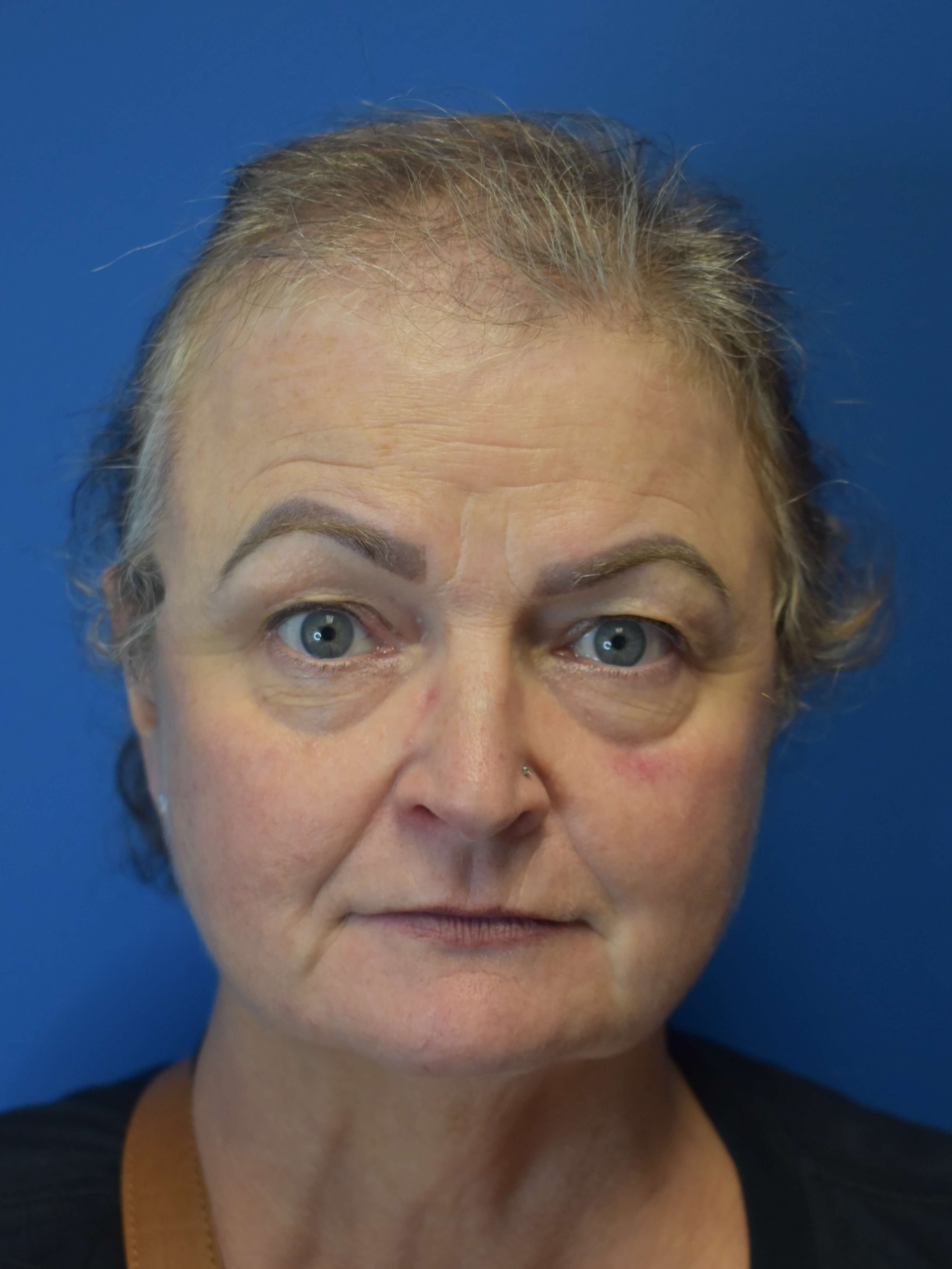 Hair Restoration Before