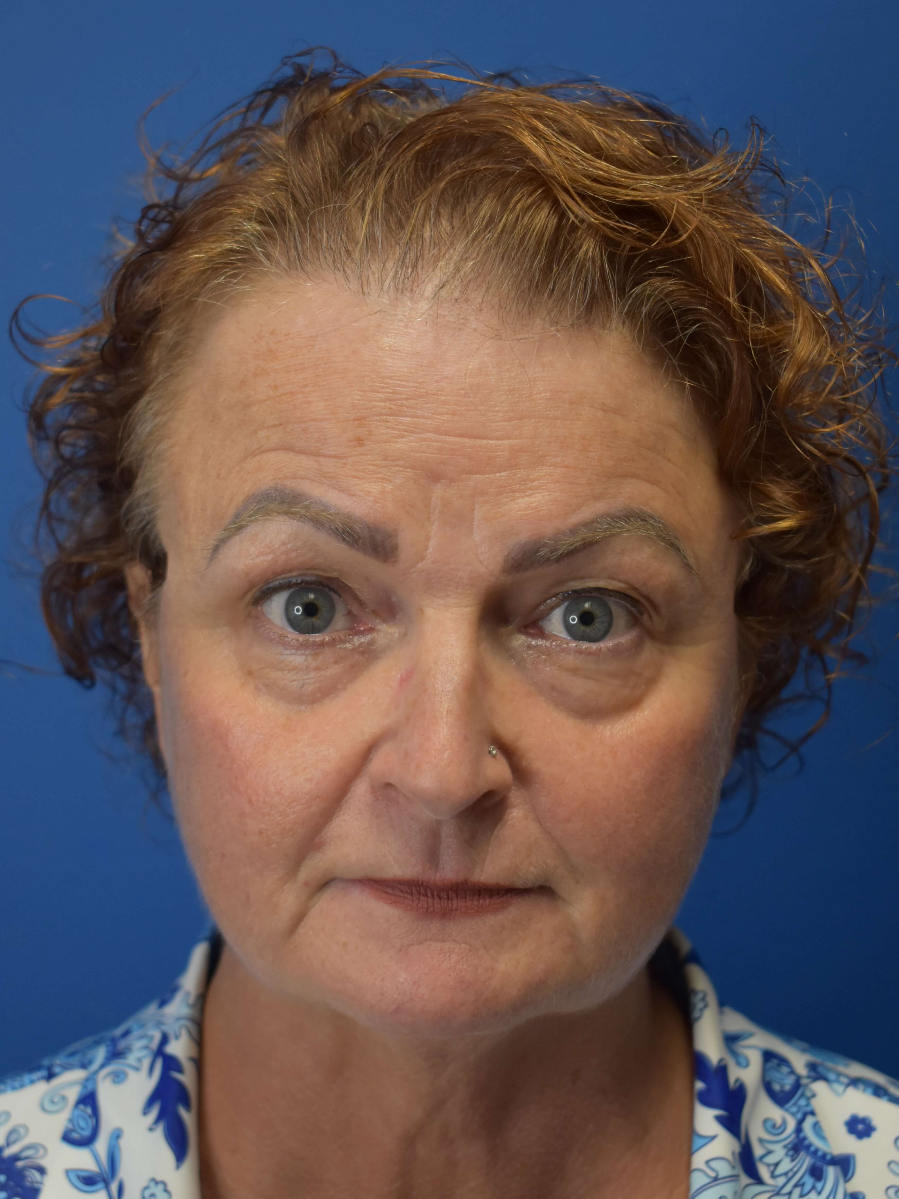 Hair Restoration After