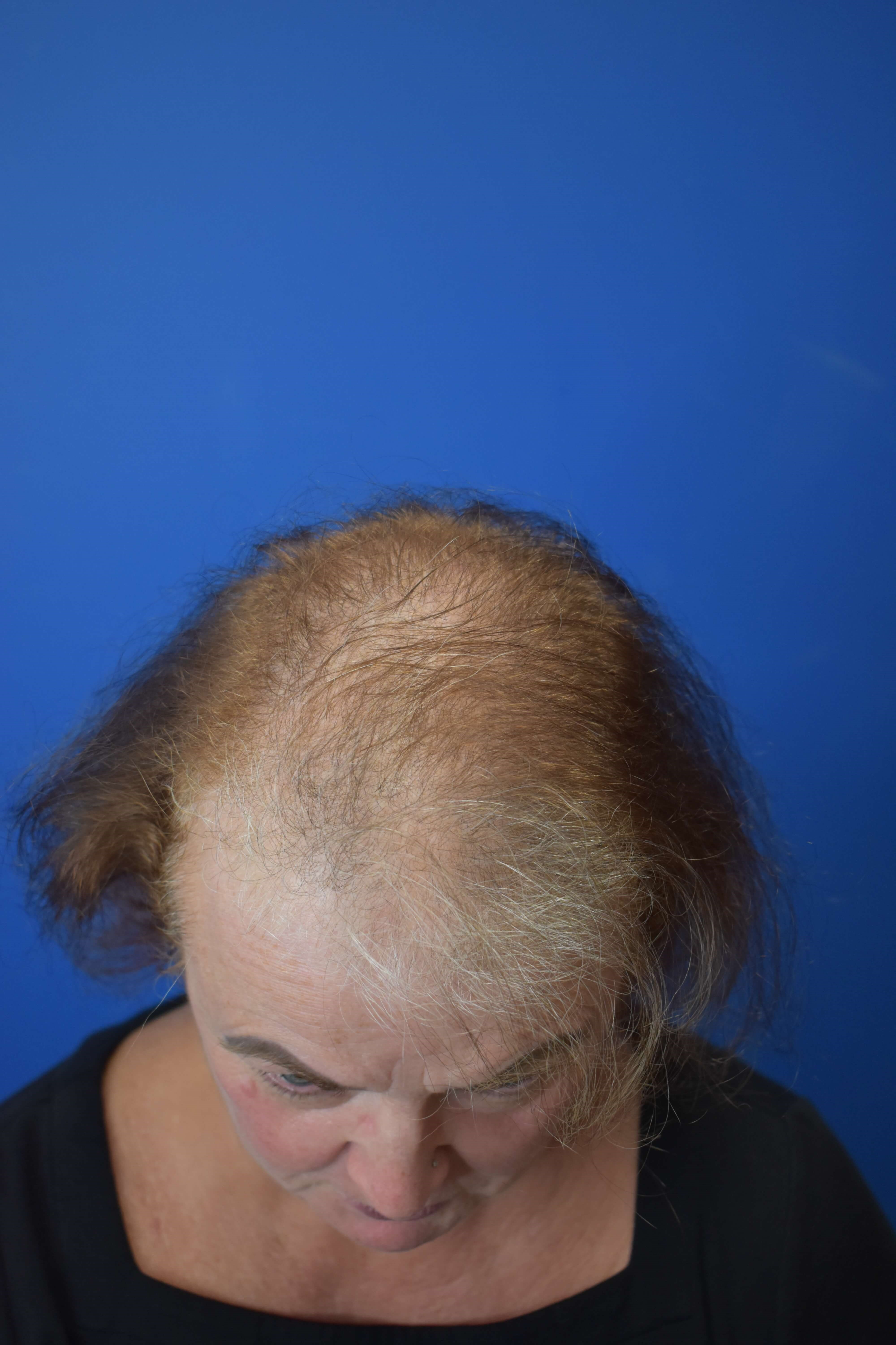 Hair Restoration Before