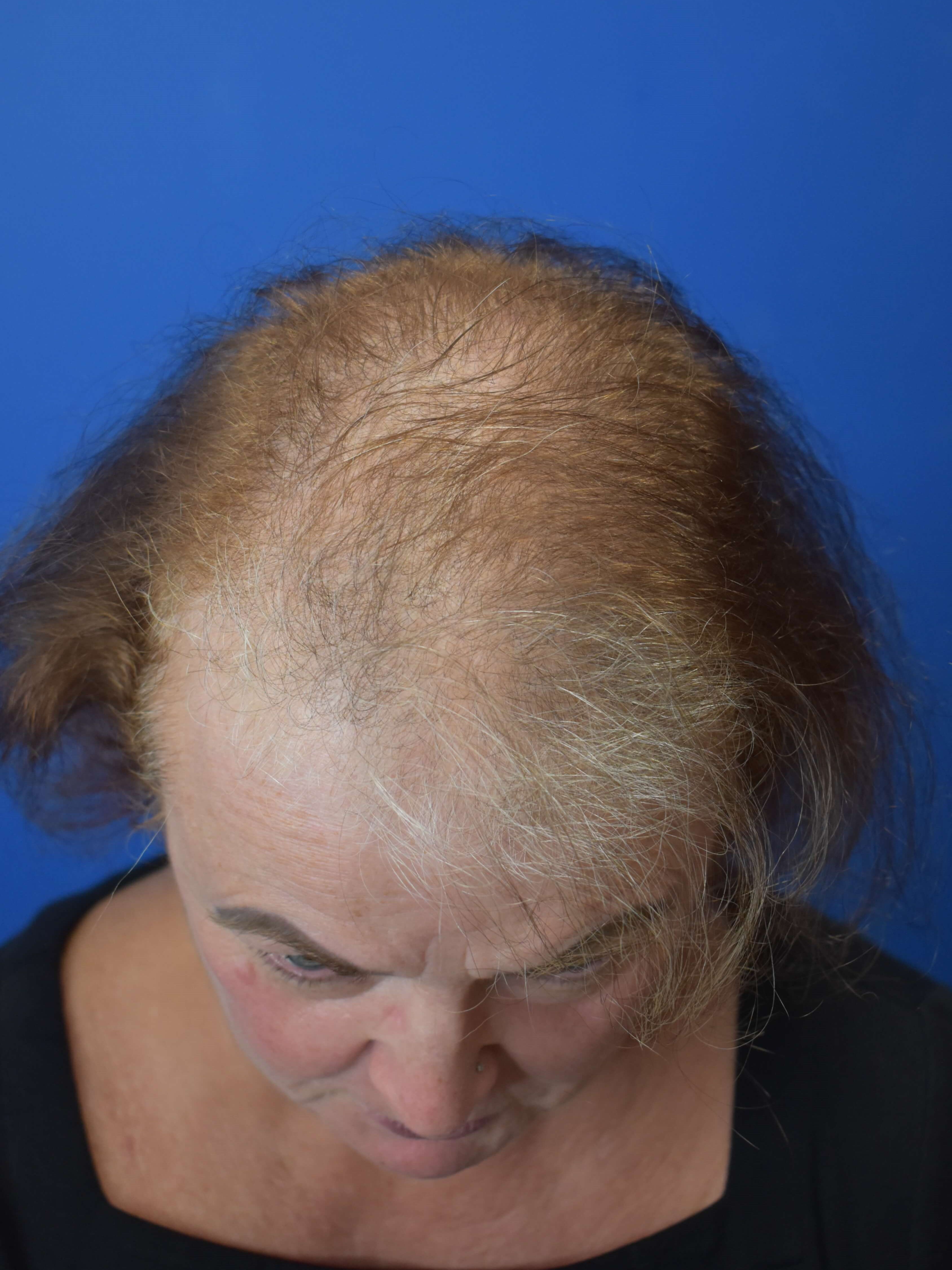 Hair Restoration Before