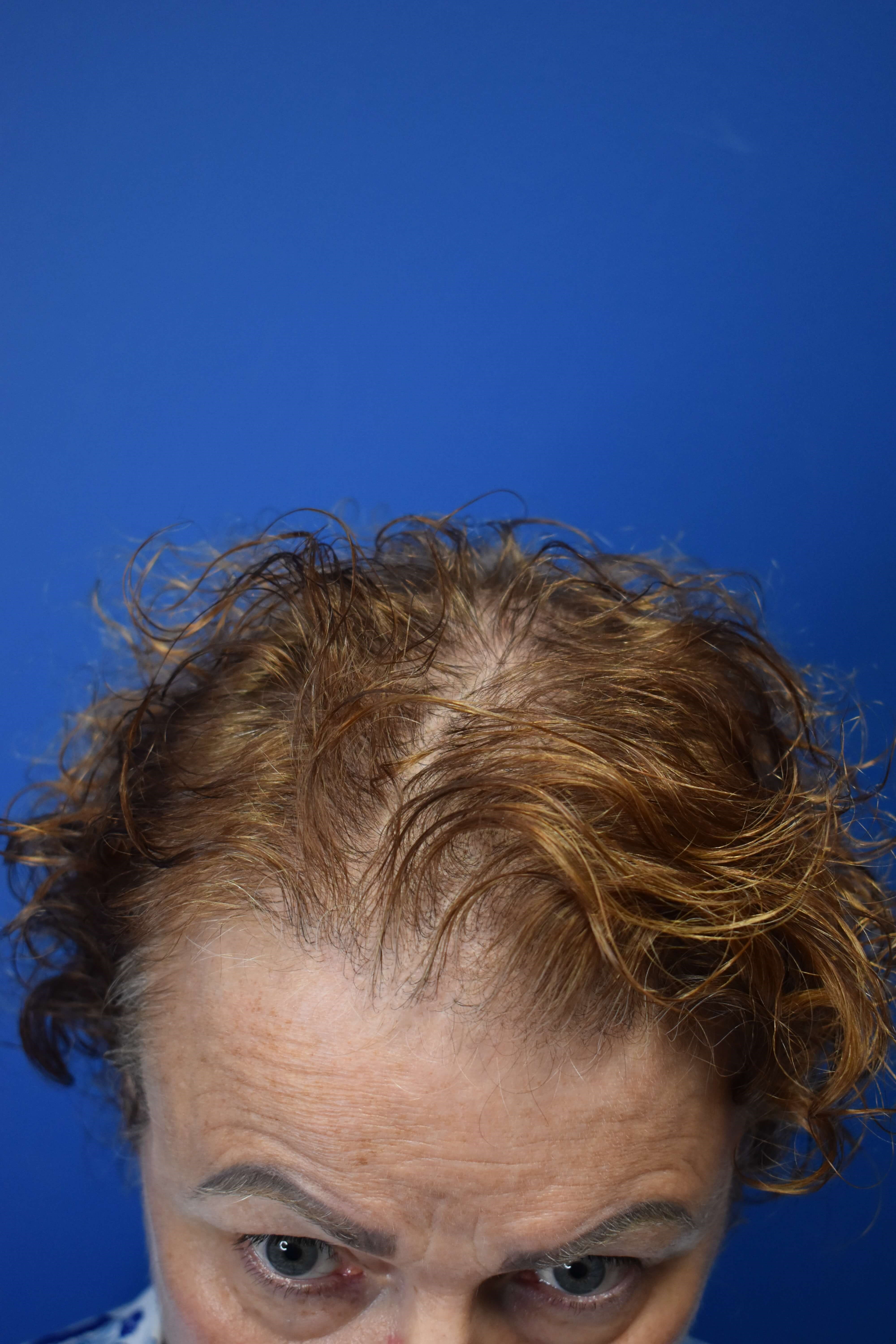 Hair Restoration After