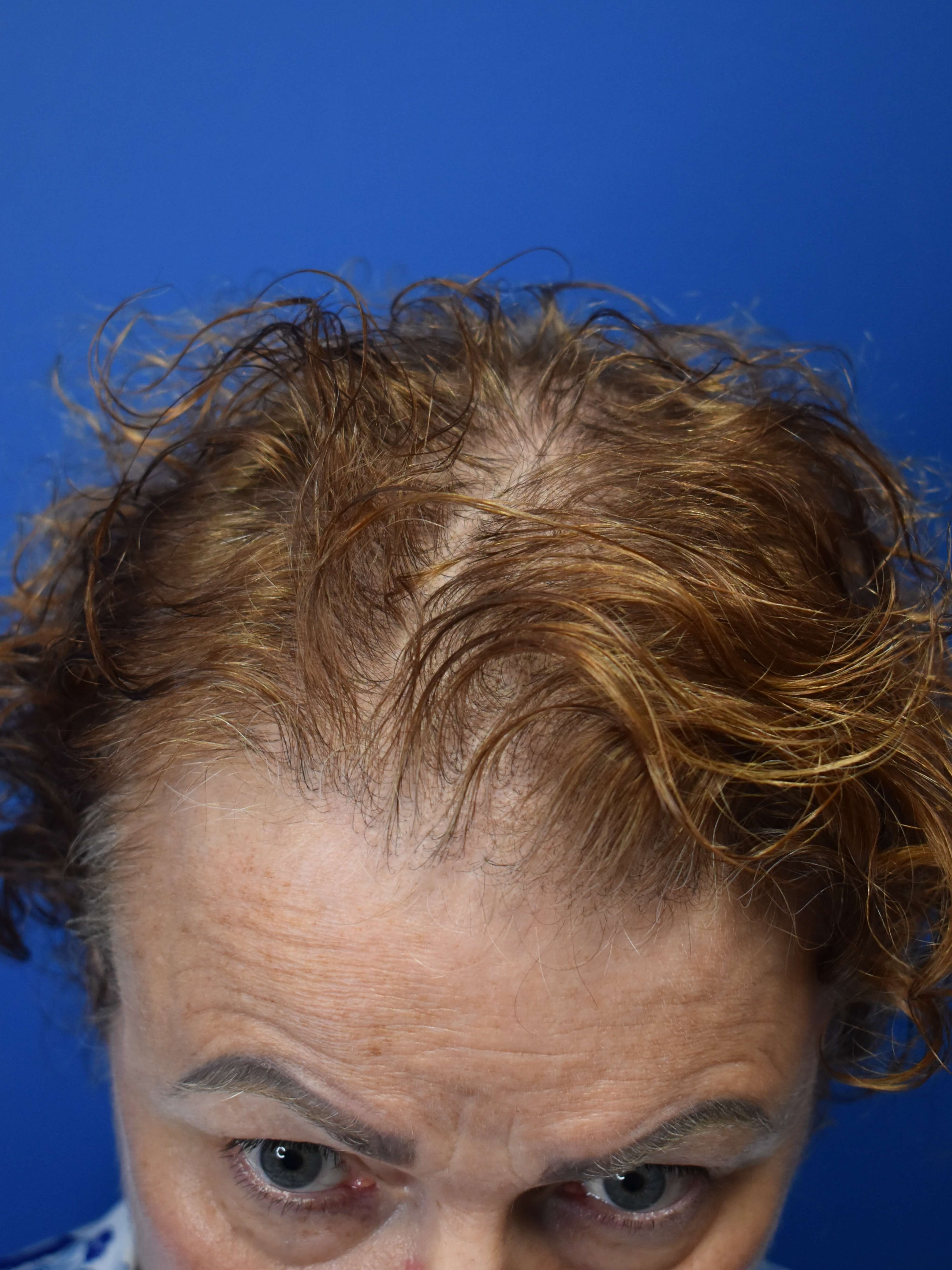 Hair Restoration After