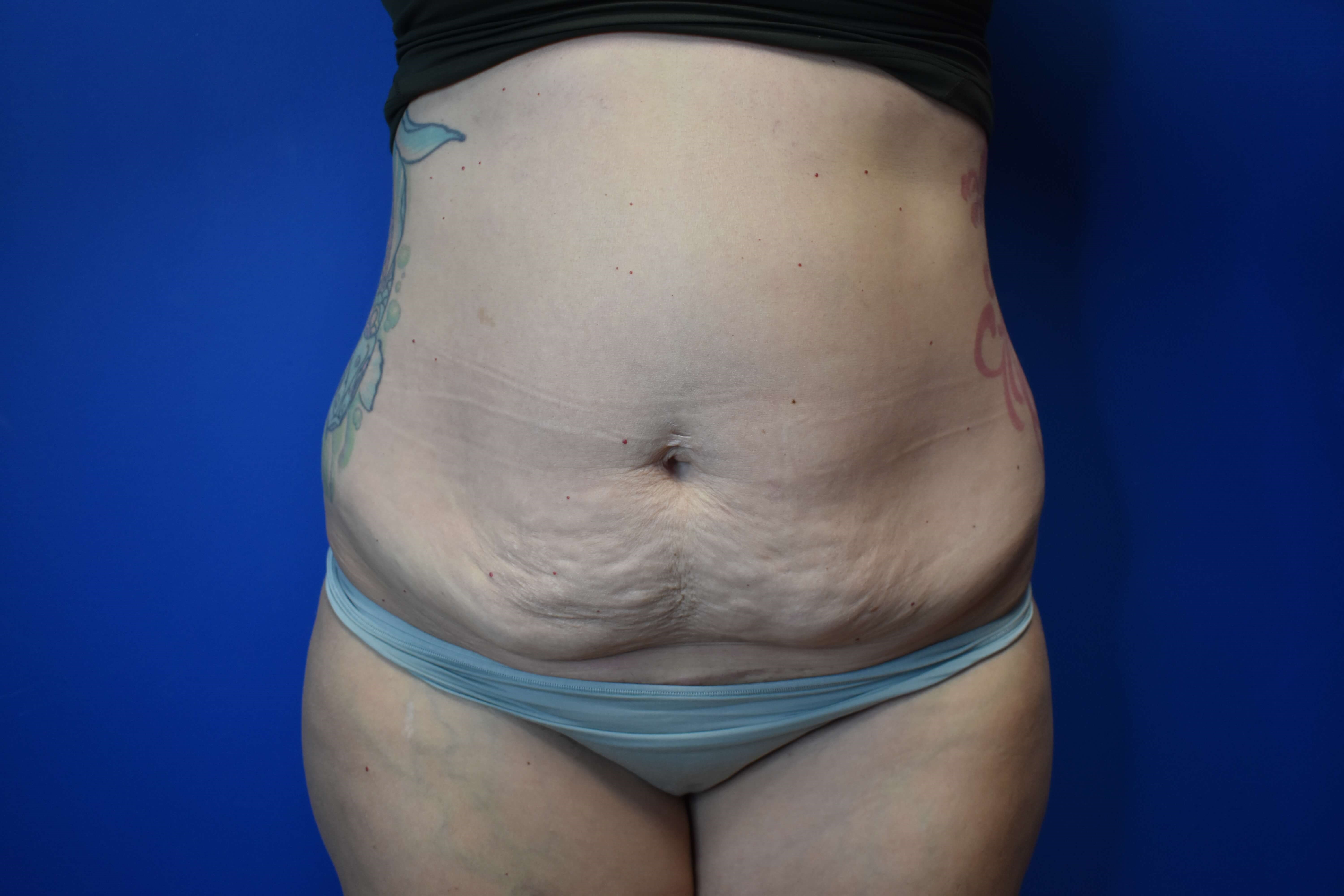 Abdominoplasty Before