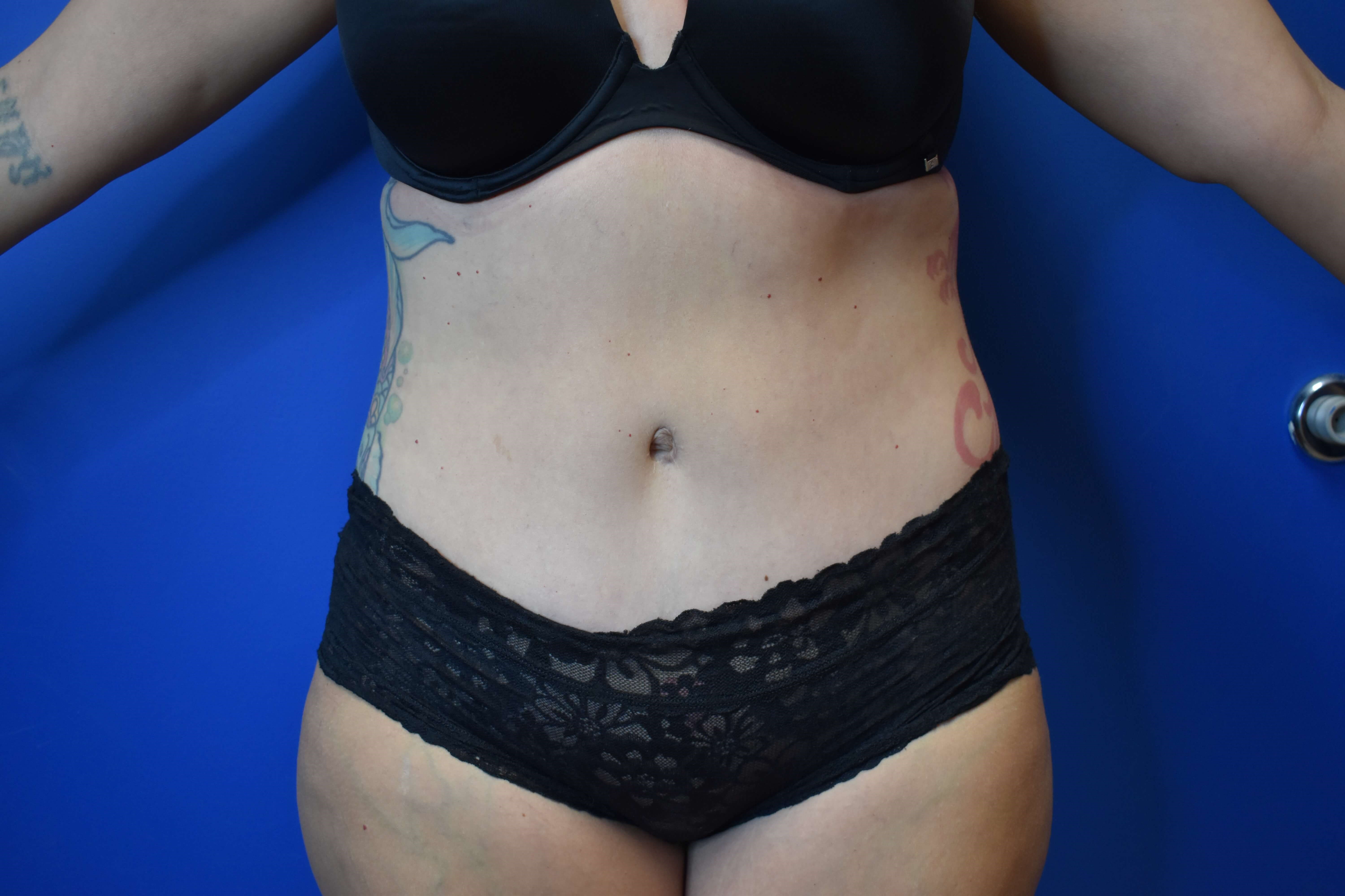 Abdominoplasty After