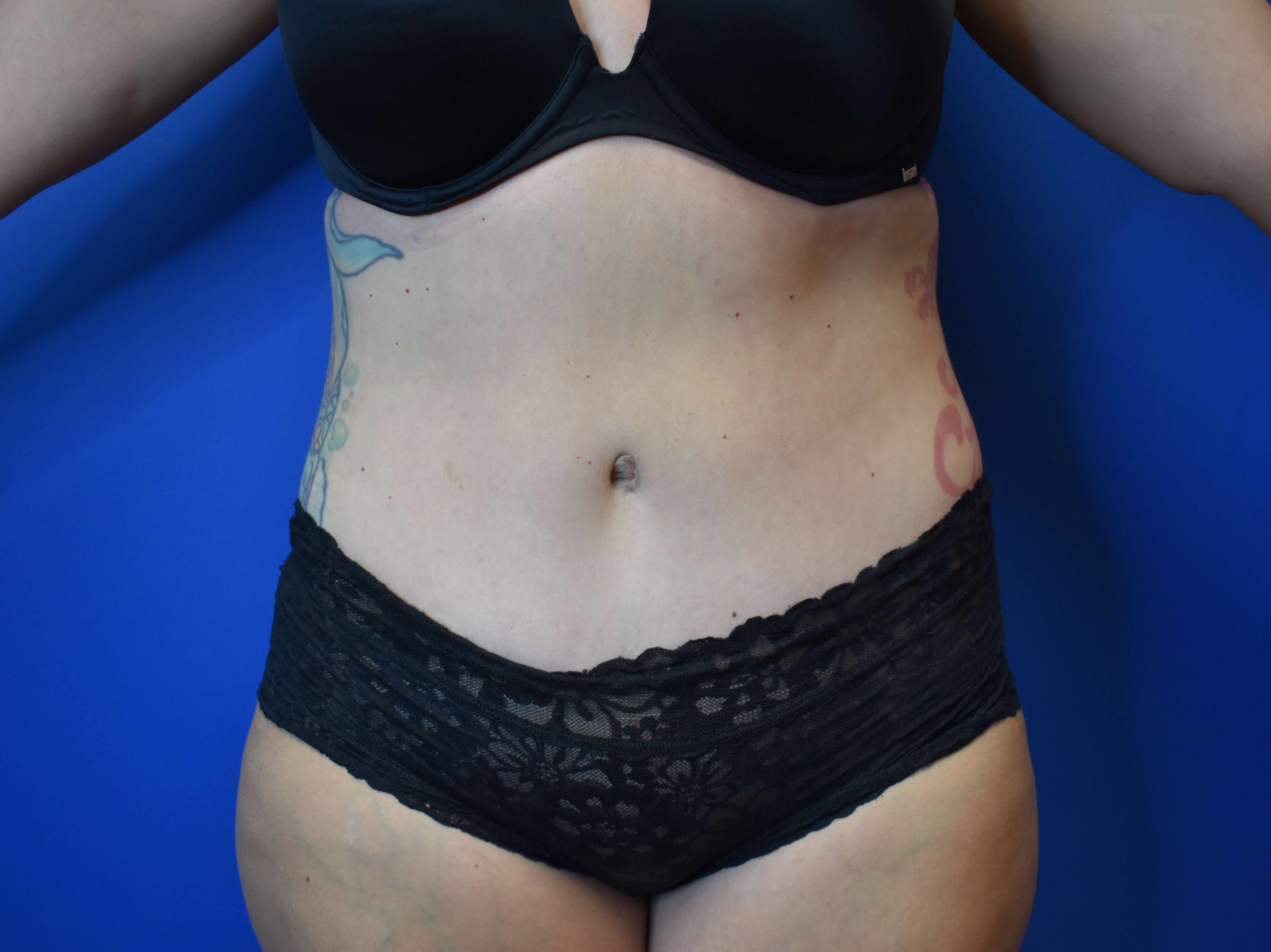 Abdominoplasty After