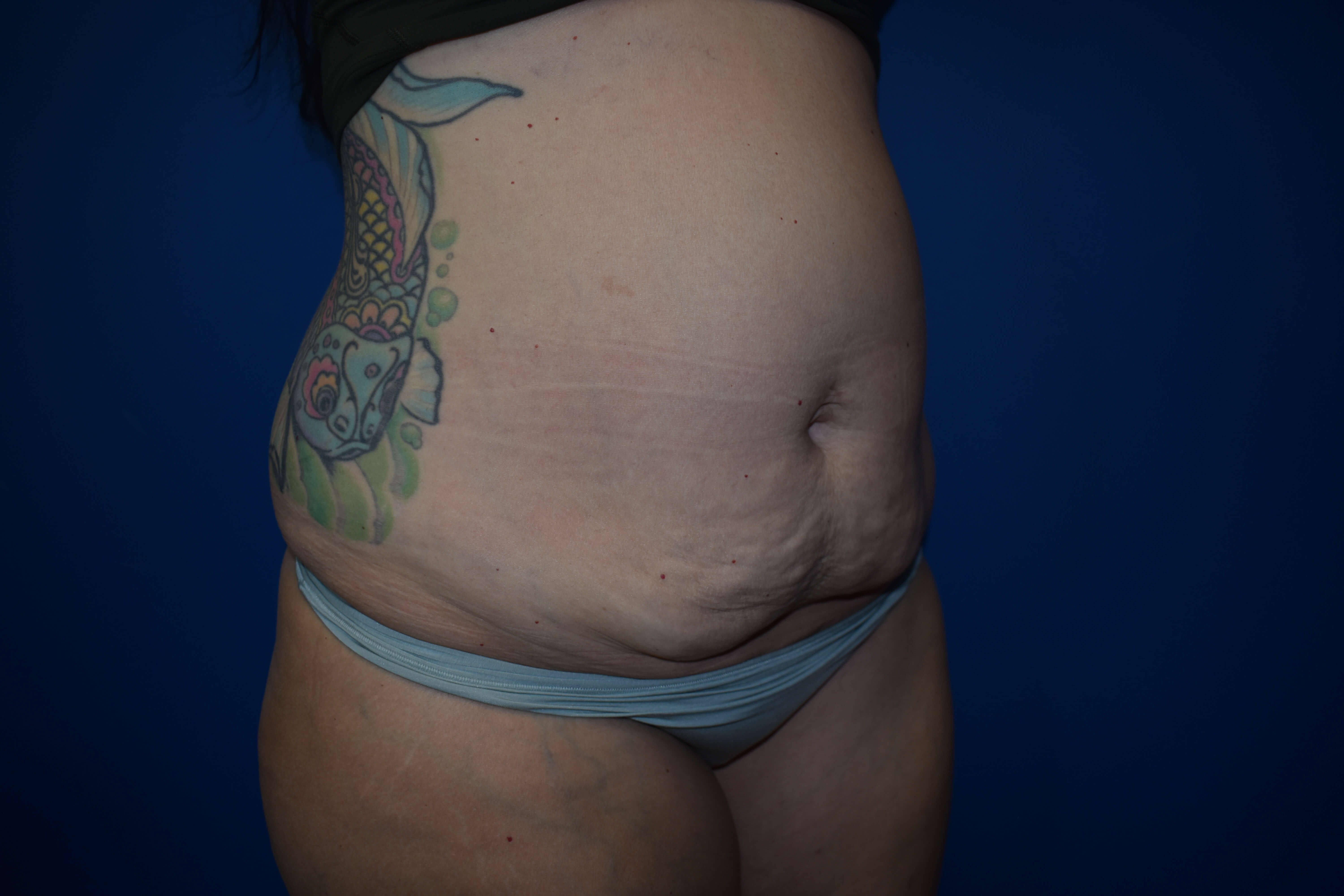 Abdominoplasty Before