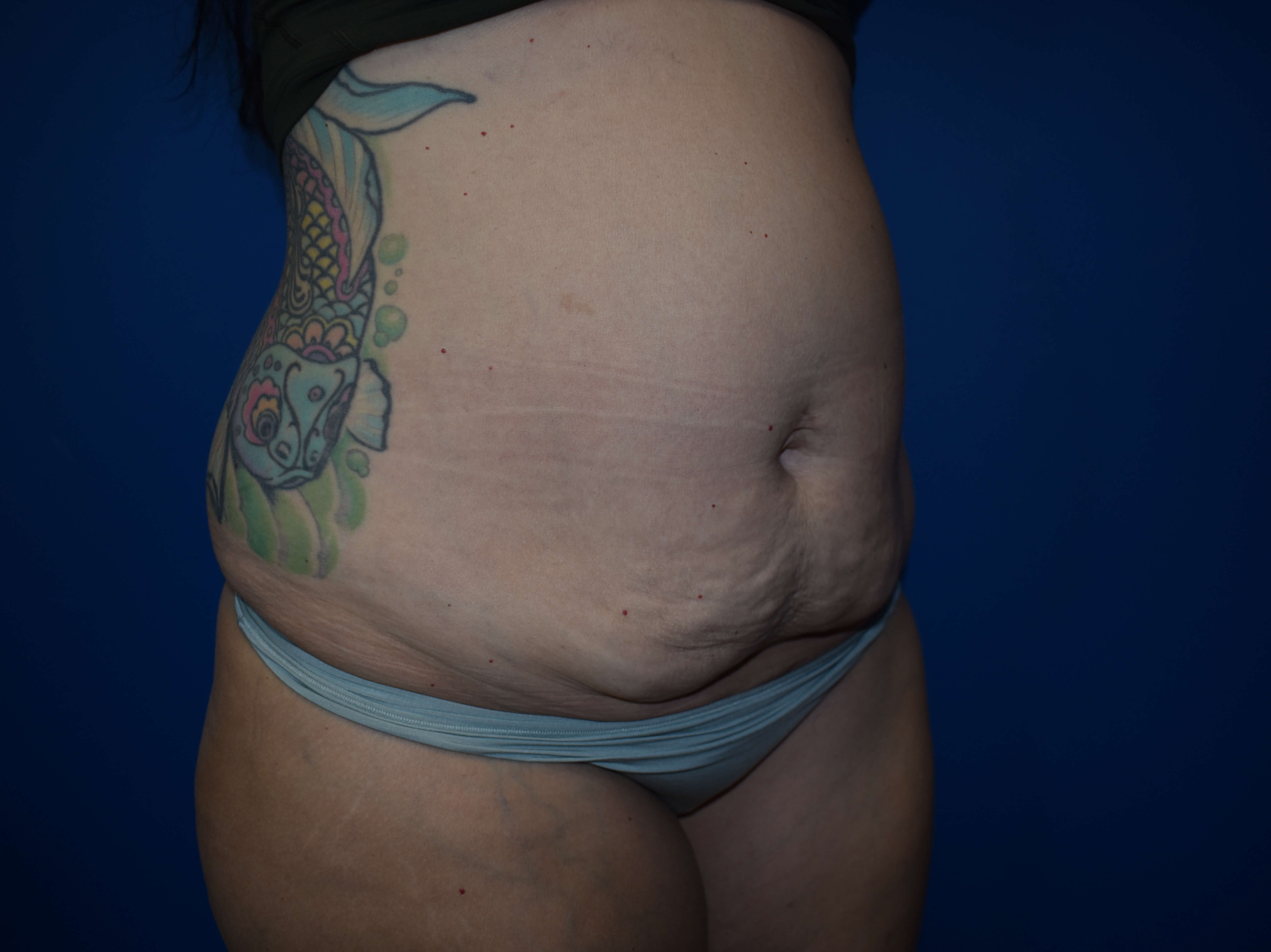 Abdominoplasty Before
