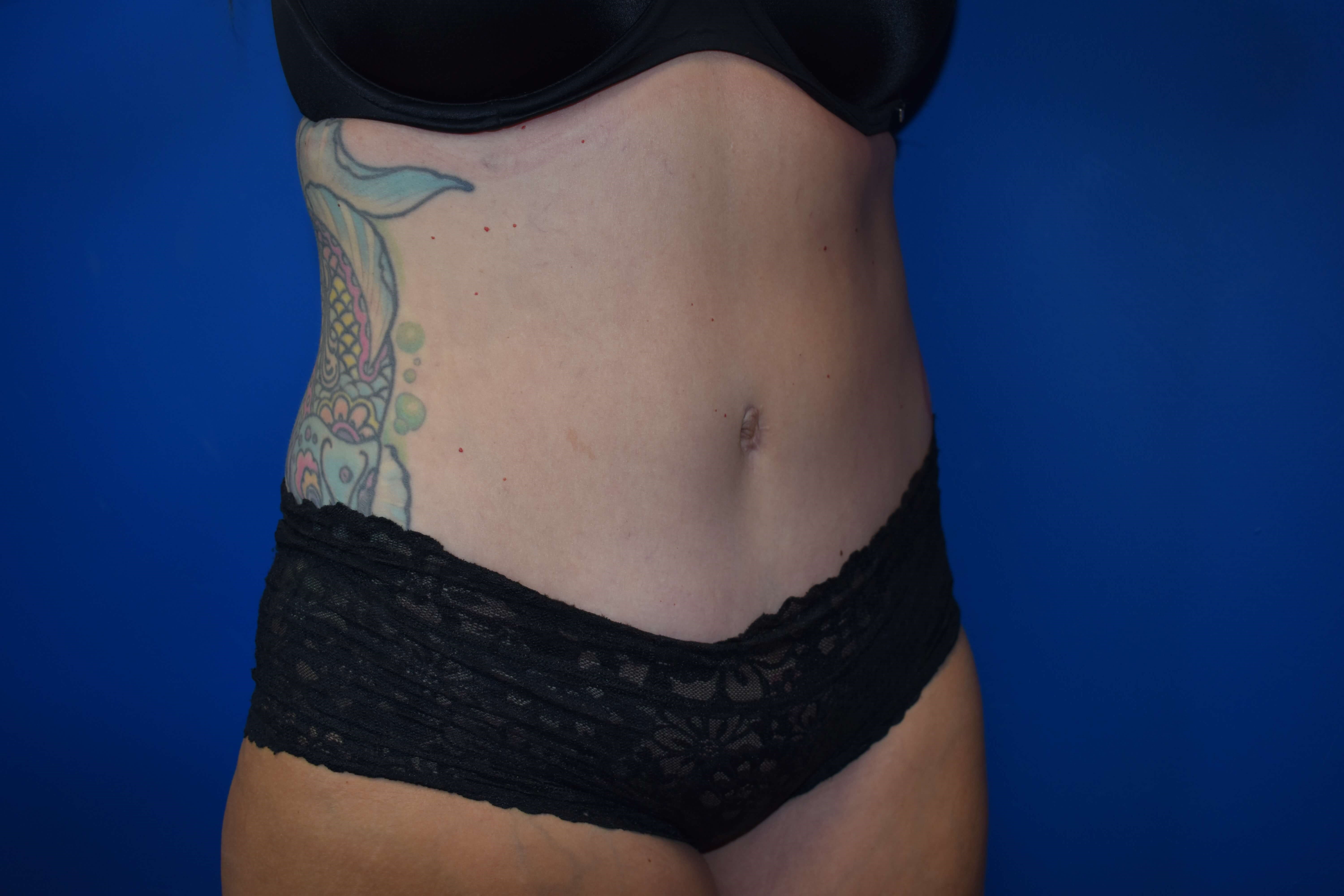 Abdominoplasty After