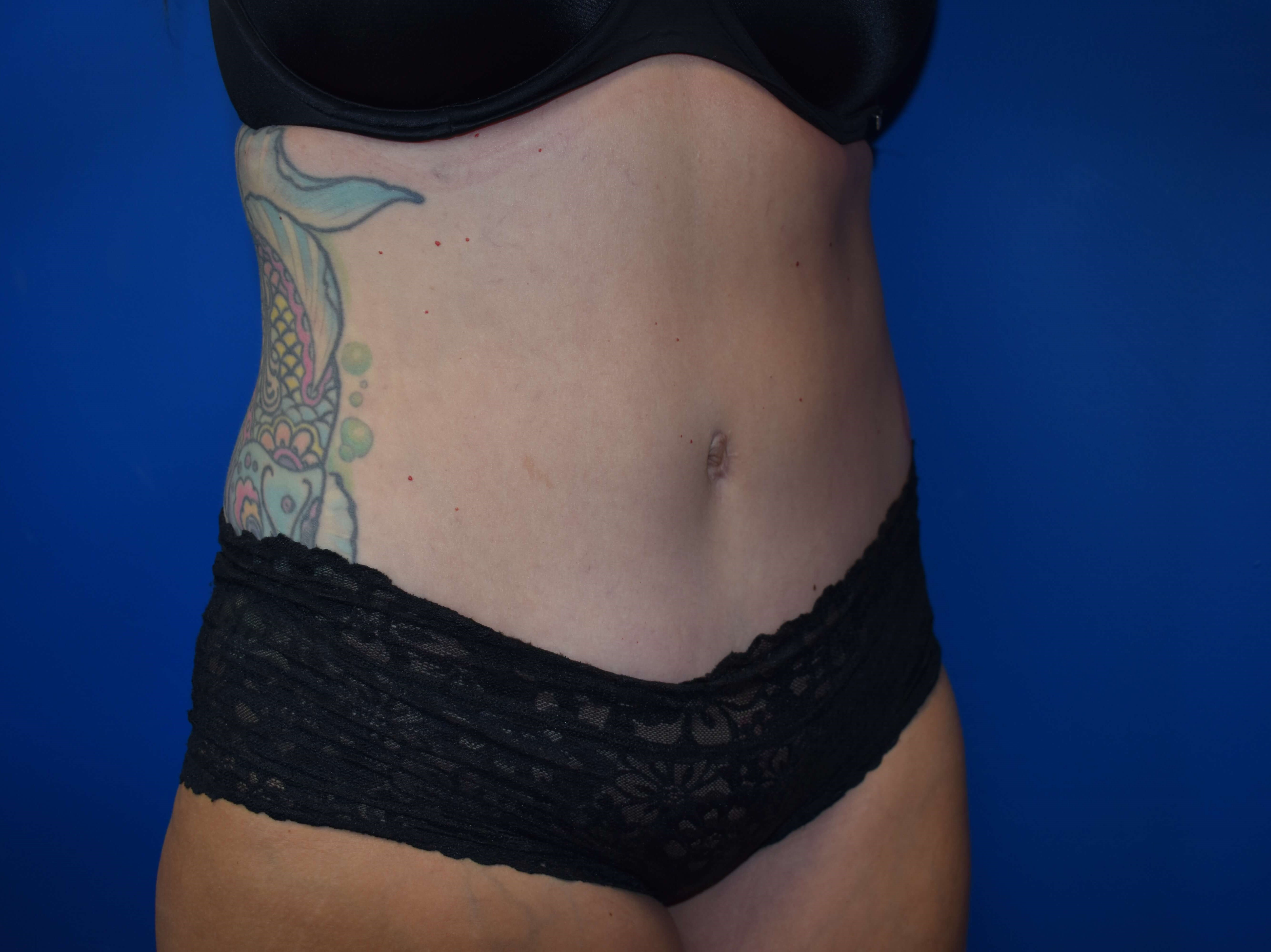 Abdominoplasty After