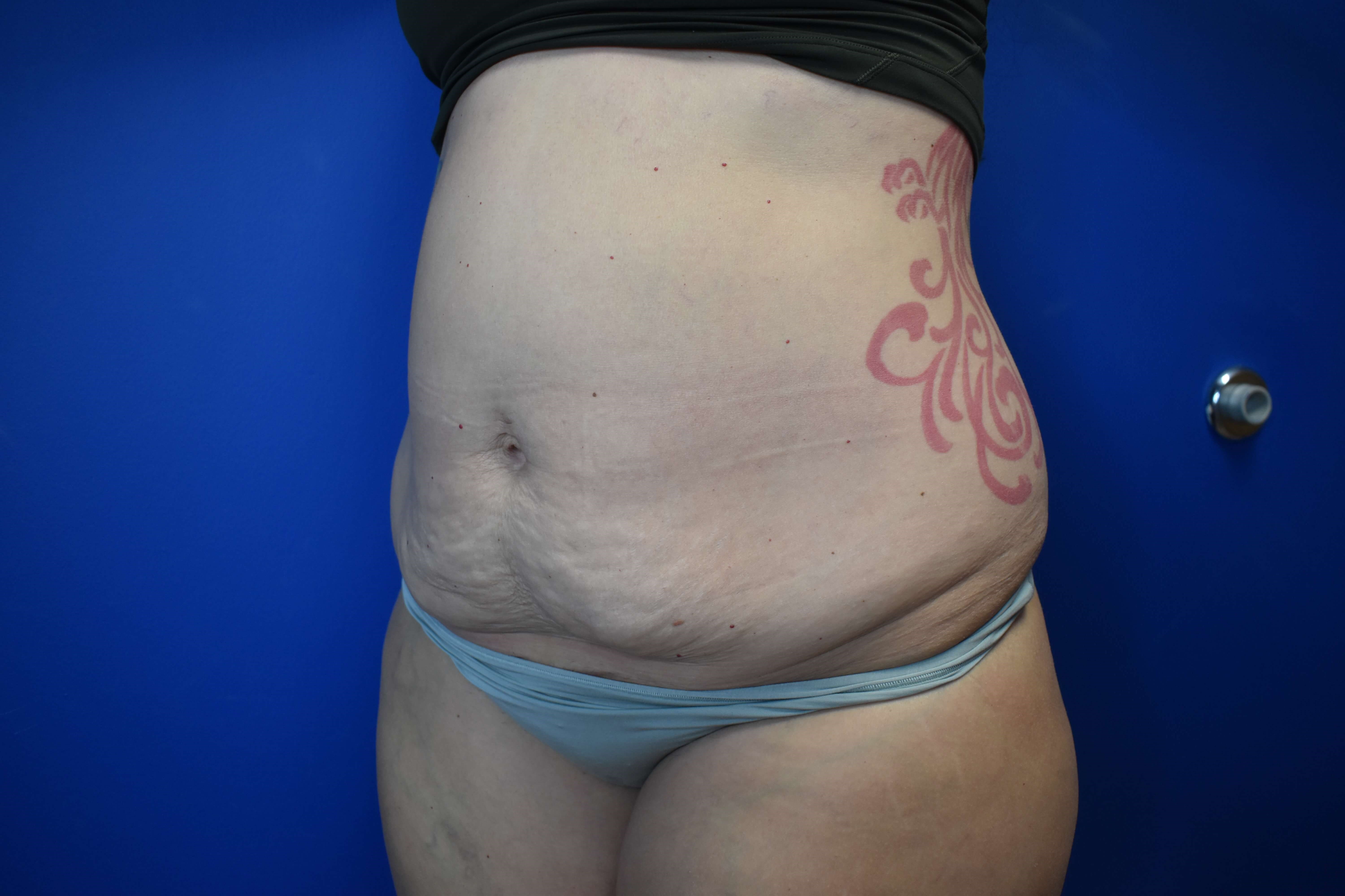 Abdominoplasty Before