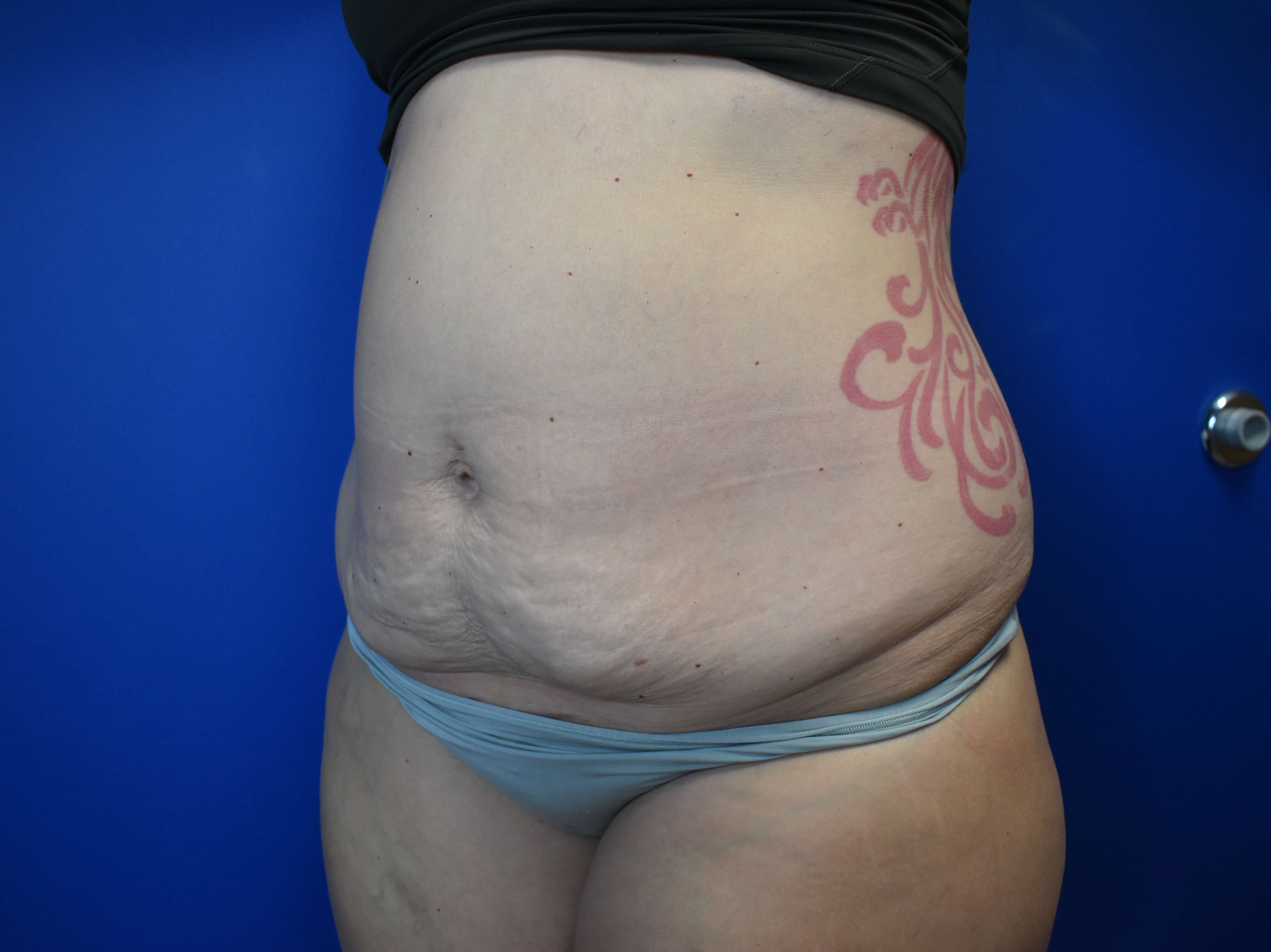 Abdominoplasty Before