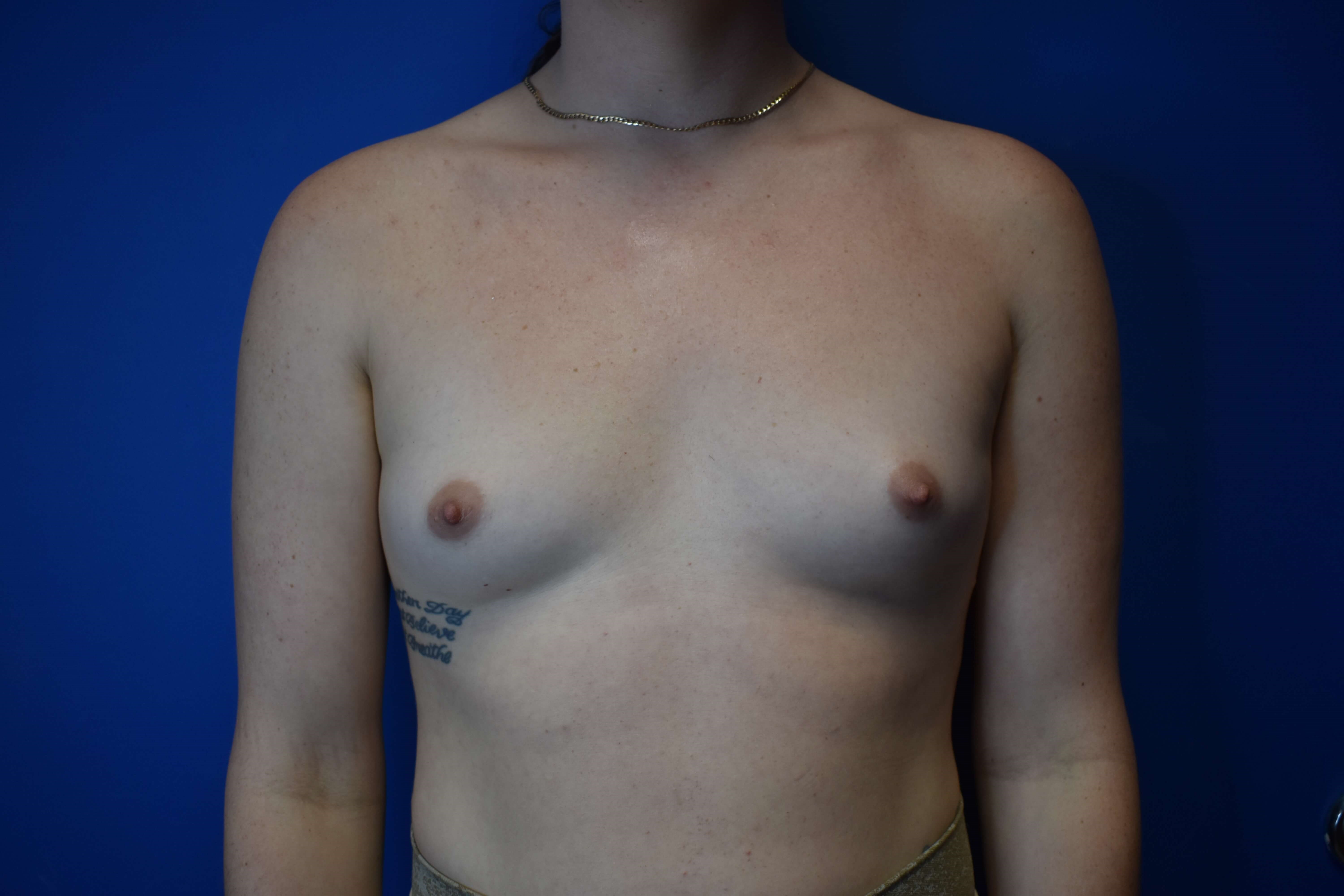 MTF Breast Augmentation Before