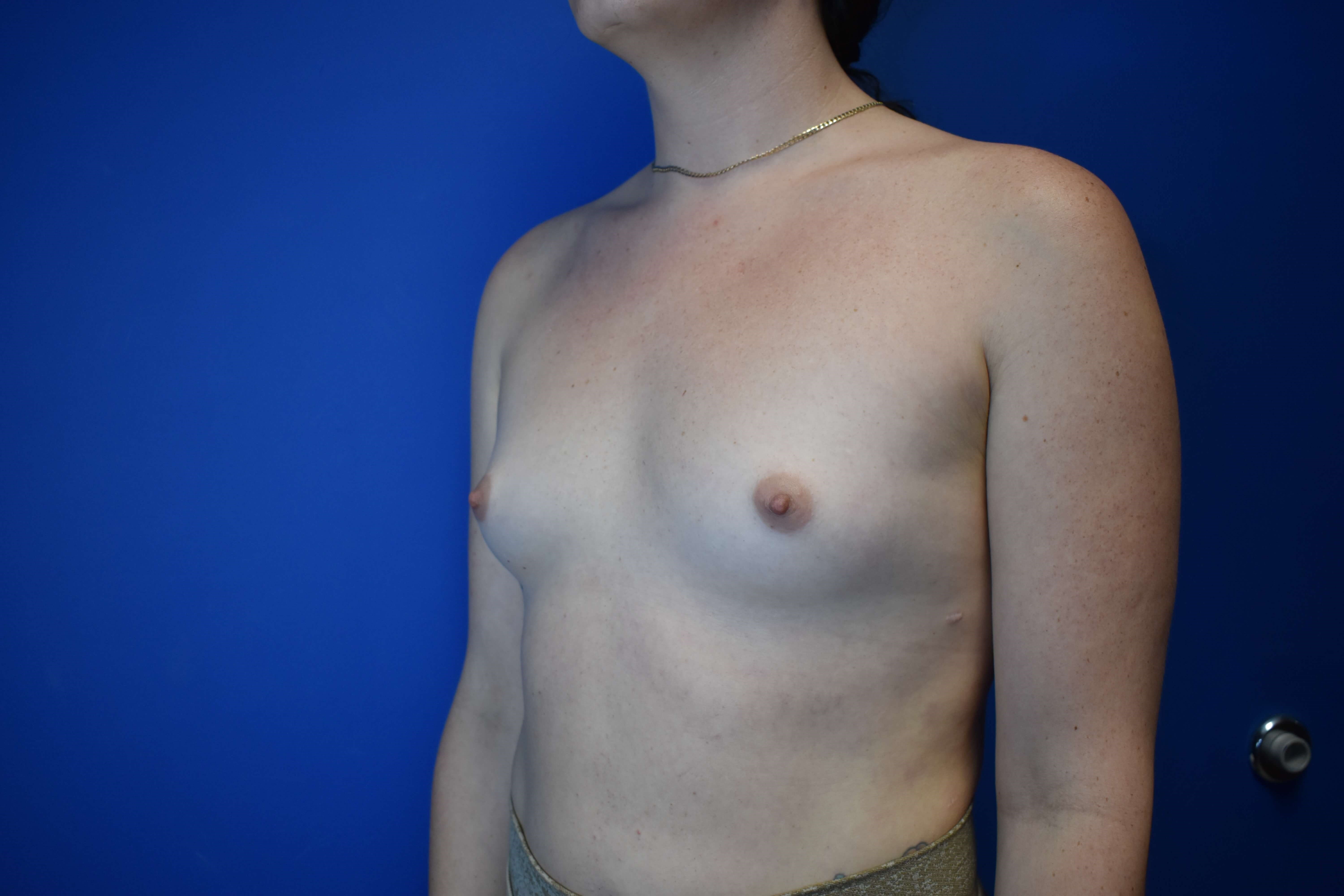 MTF Breast Augmentation Before