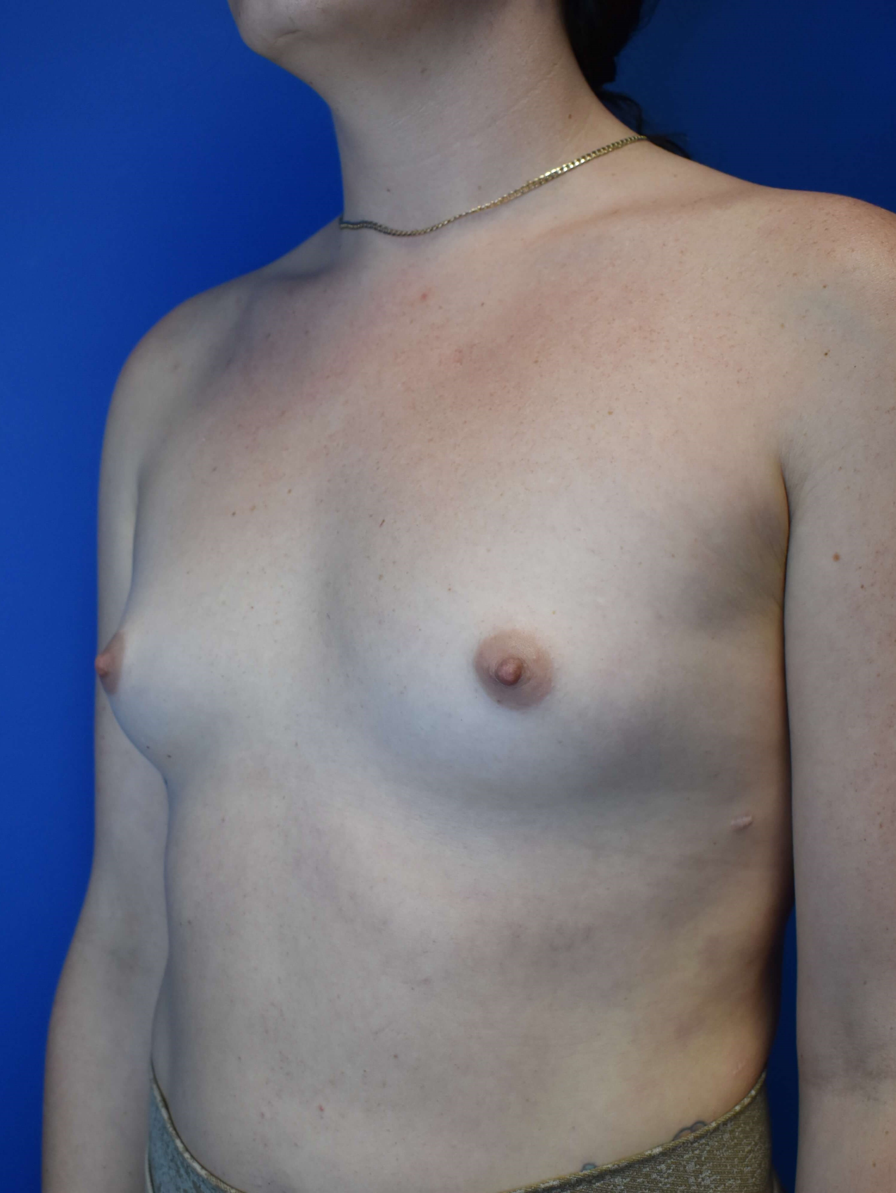 MTF Breast Augmentation Before